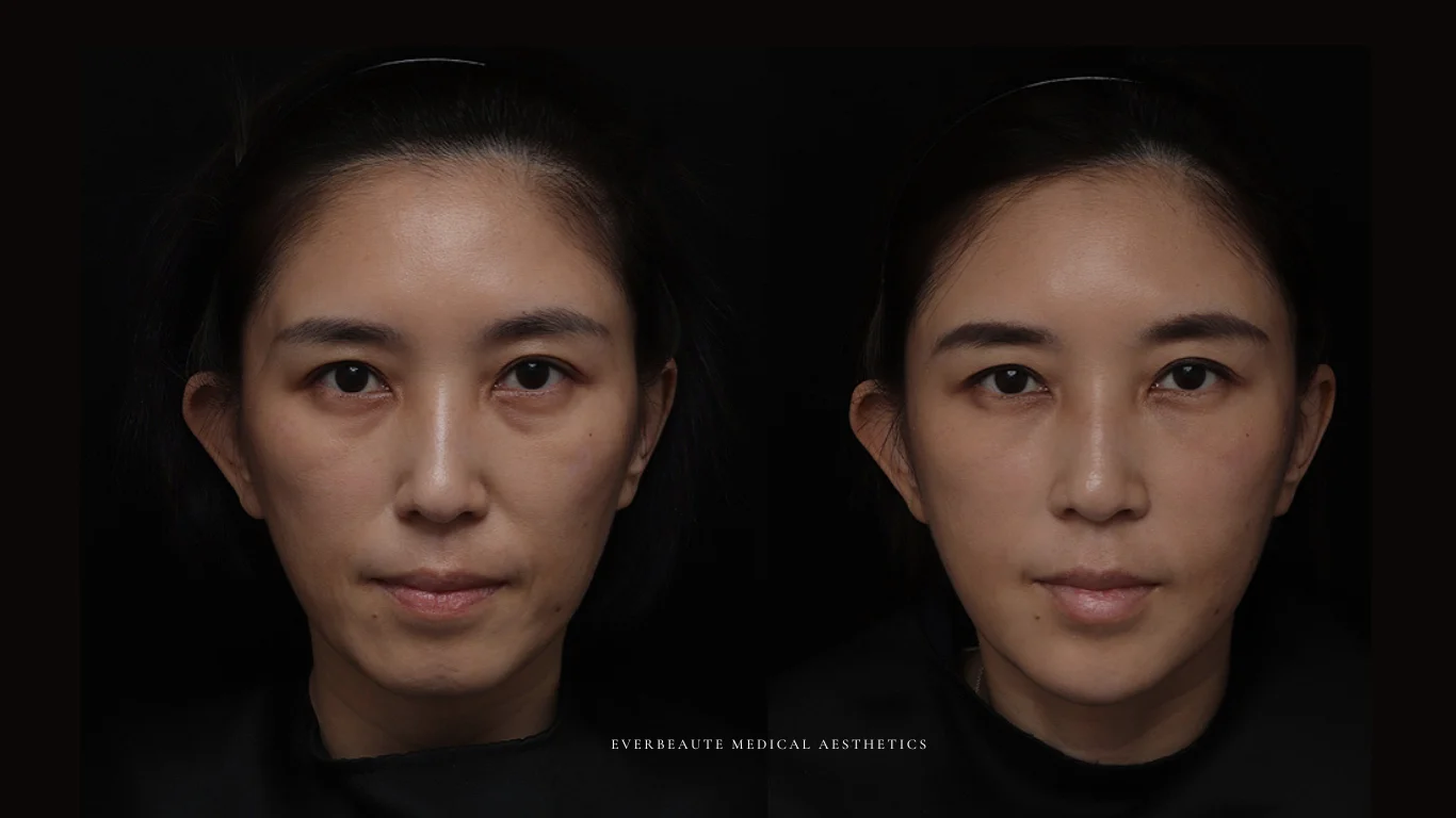 夫妻宮凹陷 太陽穴凹陷｜夫妻宮填補 台北醫美推薦 大安區醫美 桃園微整 淚溝 眼袋 黑眼圈 豐唇 木偶紋 凝境美學診所 曾繁聞醫師 于曉恩醫師 皮膚科 專科 專業 效果自然 微整形 填補 填充 瑞士緹奧希 玻尿酸 喬雅登 水無痕 保柔緹 女神動態 熊貓針 淚溝針 童顏針 伊蓮絲 精靈針 喬雅露 逆時針 價格 副作用 後遺症 dcard ptt 成功案例 玻尿酸豐唇前後對比 豐唇、玻尿酸豐唇、自然豐唇、唇形改善、唇線重塑、唇峰設計、唇部微整形、豐唇注射推薦、自然飽滿唇、唇部玻尿酸 20 凝境美學診所院長醫師擔任精靈針Aesthefill艾麗斯原廠國際級講師 示範注射教學案例 豐唇、太陽穴、臉頰凹陷、淚溝、蘋果肌 4