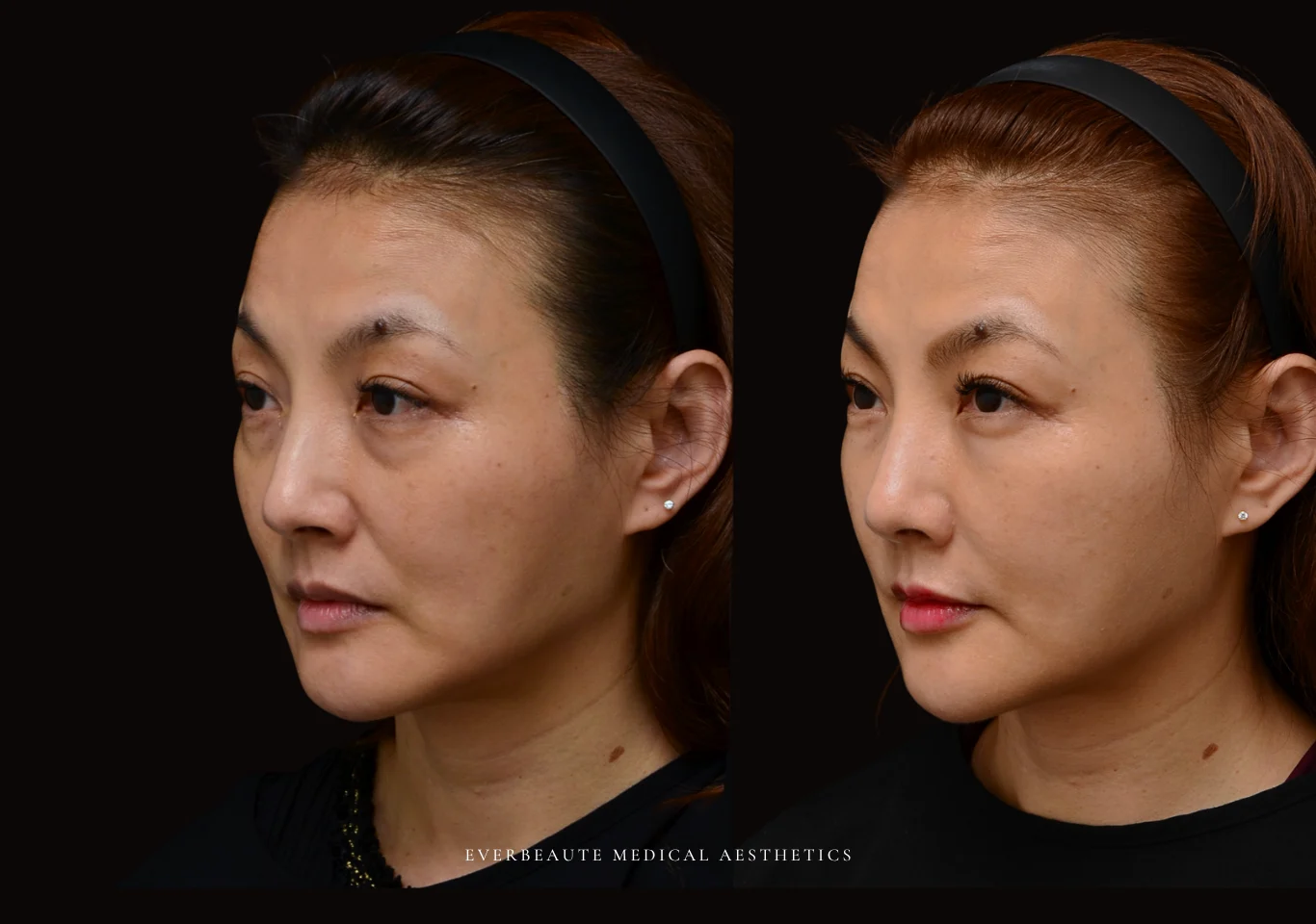 台北醫美推薦 大安區醫美 桃園微整 淚溝 眼袋 黑眼圈 法令紋 非手術 無痕拉提 凝境美學診所 曾繁聞醫師 于曉恩醫師 皮膚科 專科 專業 效果自然 微整形 填補 填充 瑞士緹奧希 玻尿酸 喬雅登 水無痕 保柔緹 女神動態 熊貓針 淚溝針 童顏針 伊蓮絲 精靈針 喬雅露 逆時針 價格 副作用 後遺症 dcard ptt 成功案例3331