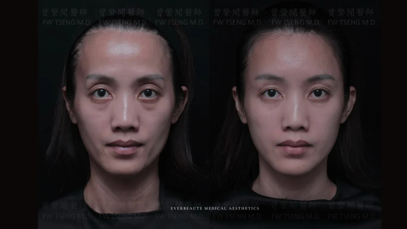 台北醫美推薦 大安區醫美 桃園微整 淚溝 眼袋 黑眼圈 豐唇 木偶紋 凝境美學診所 曾繁聞醫師 于曉恩醫師 皮膚科 專科 專業 效果自然 微整形 填補 填充 瑞士緹奧希 玻尿酸 喬雅登 水無痕 保柔緹 女神動態 熊貓針 淚溝針 童顏針 伊蓮絲 精靈針 喬雅露 逆時針 價格 副作用 後遺症 dcard ptt 成功案例 玻尿酸豐唇前後對比 豐唇、玻尿酸豐唇、自然豐唇、唇形改善、唇線重塑、唇峰設計、唇部微整形、豐唇注射推薦、自然飽滿唇、唇部玻尿酸 16