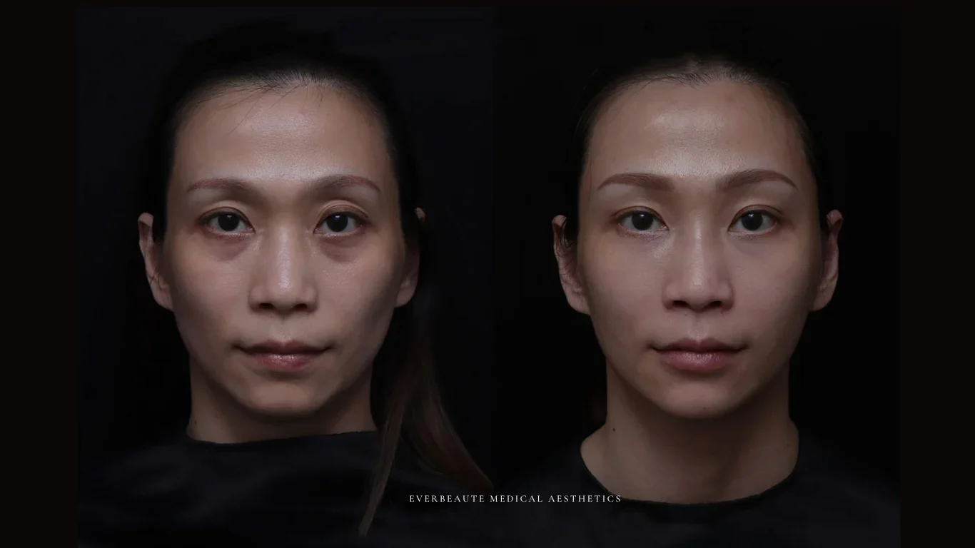 台北醫美推薦 大安區醫美 桃園微整 淚溝 眼袋 黑眼圈 豐唇 木偶紋 凝境美學診所 曾繁聞醫師 于曉恩醫師 皮膚科 專科 專業 效果自然 微整形 填補 填充 瑞士緹奧希 玻尿酸 喬雅登 水無痕 保柔緹 女神動態 熊貓針 淚溝針 童顏針 伊蓮絲 精靈針 喬雅露 逆時針 價格 副作用 後遺症 dcard ptt 成功案例 玻尿酸豐唇前後對比 豐唇、玻尿酸豐唇、自然豐唇、唇形改善、唇線重塑、唇峰設計、唇部微整形、豐唇注射推薦、自然飽滿唇、唇部玻尿酸 17