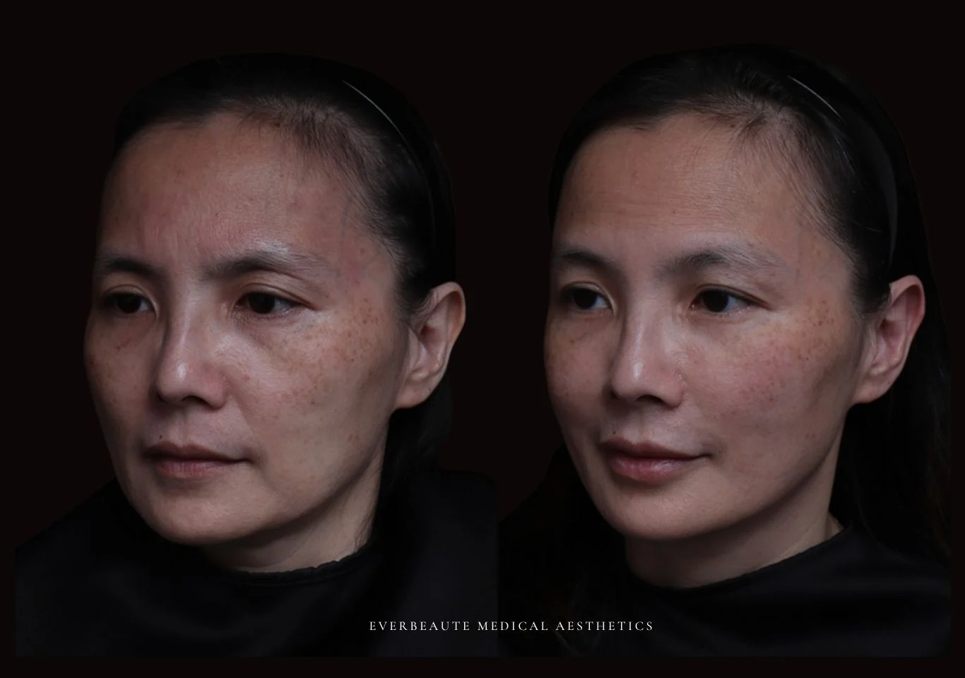 台北醫美推薦 大安區醫美 桃園微整 淚溝 眼袋 黑眼圈 豐唇 木偶紋 凝境美學診所 曾繁聞醫師 于曉恩醫師 皮膚科 專科 專業 效果自然 微整形 填補 填充 瑞士緹奧希 玻尿酸 喬雅登 水無痕 保柔緹 女神動態 熊貓針 淚溝針 童顏針 伊蓮絲 精靈針 喬雅露 逆時針 價格 副作用 後遺症 dcard ptt 成功案例 玻尿酸豐唇前後對比 豐唇、玻尿酸豐唇、自然豐唇、唇形改善、唇線重塑、唇峰設計、唇部微整形、豐唇注射推薦、自然飽滿唇、唇部玻尿酸 台北醫美