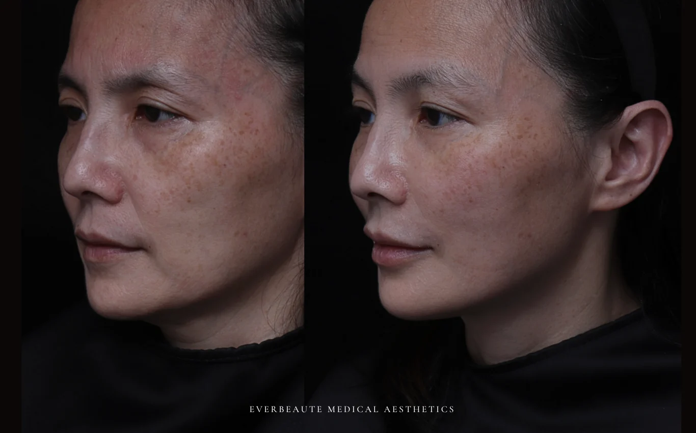 台北醫美推薦 大安區醫美 桃園微整 淚溝 眼袋 黑眼圈 木偶紋 蘋果肌 印地安紋 貓咪紋 嘴邊肉下垂 非手術 無痕拉提 凝境美學診所 曾繁聞醫師 于曉恩醫師 皮膚科 專科 專業 效果自然 微整形 填補 填充 瑞士緹奧希 玻尿酸 喬雅登 水無痕 保柔緹 女神動態 熊貓針 淚溝針 童顏針 伊蓮絲 精靈針 喬雅露 逆時針 價格 副作用 後遺症 dcard ptt 成功案例 台北醫美