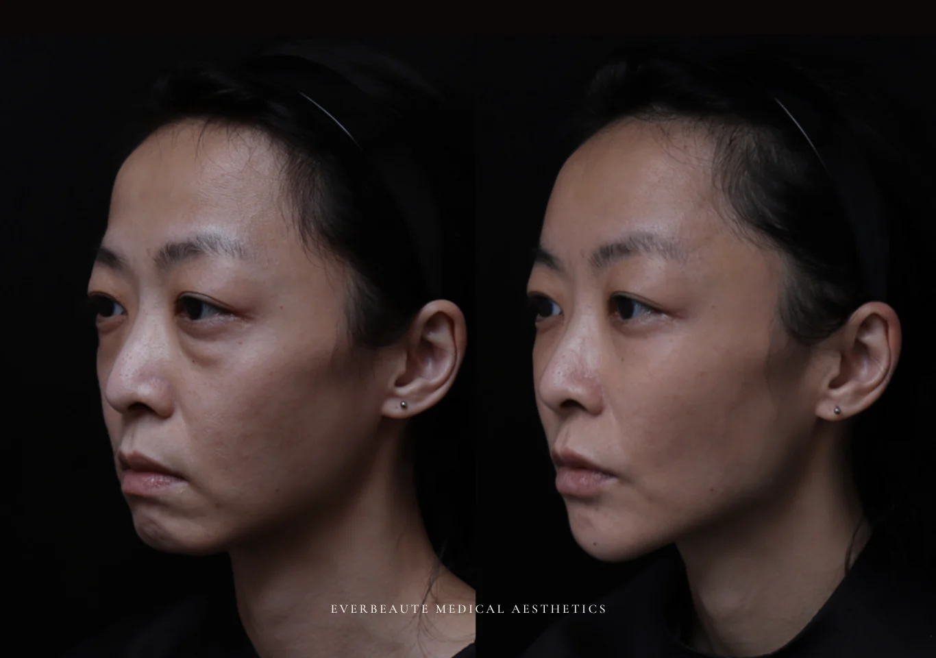 台北醫美推薦 大安區醫美 桃園微整 淚溝 眼袋 黑眼圈 木偶紋 蘋果肌 印地安紋 貓咪紋 嘴邊肉下垂 非手術 無痕拉提 凝境美學診所 曾繁聞醫師 于曉恩醫師 皮膚科 專科 專業 效果自然 微整形 填補 填充 瑞士緹奧希 玻尿酸 喬雅登 水無痕 保柔緹 女神動態 熊貓針 淚溝針 童顏針 伊蓮絲 精靈針 喬雅露 逆時針 價格 副作用 後遺症 dcard ptt 成功案例 02f