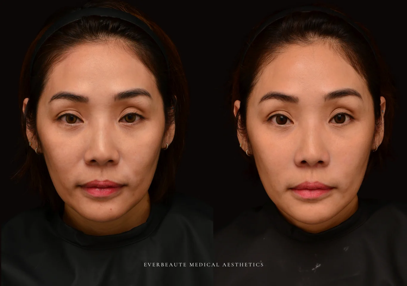 台北醫美推薦 大安區醫美 桃園微整 法令紋 非手術 無痕拉提 凝境美學診所 曾繁聞醫師 于曉恩醫師 皮膚科 專科 專業 效果自然 微整形 填補 填充 瑞士緹奧希 玻尿酸 喬雅登 水無痕 保柔緹 女神動態 熊貓針 淚溝針 童顏針 伊蓮絲 精靈針 喬雅露 逆時針 價格 副作用 後遺症 dcard ptt 成功案例2