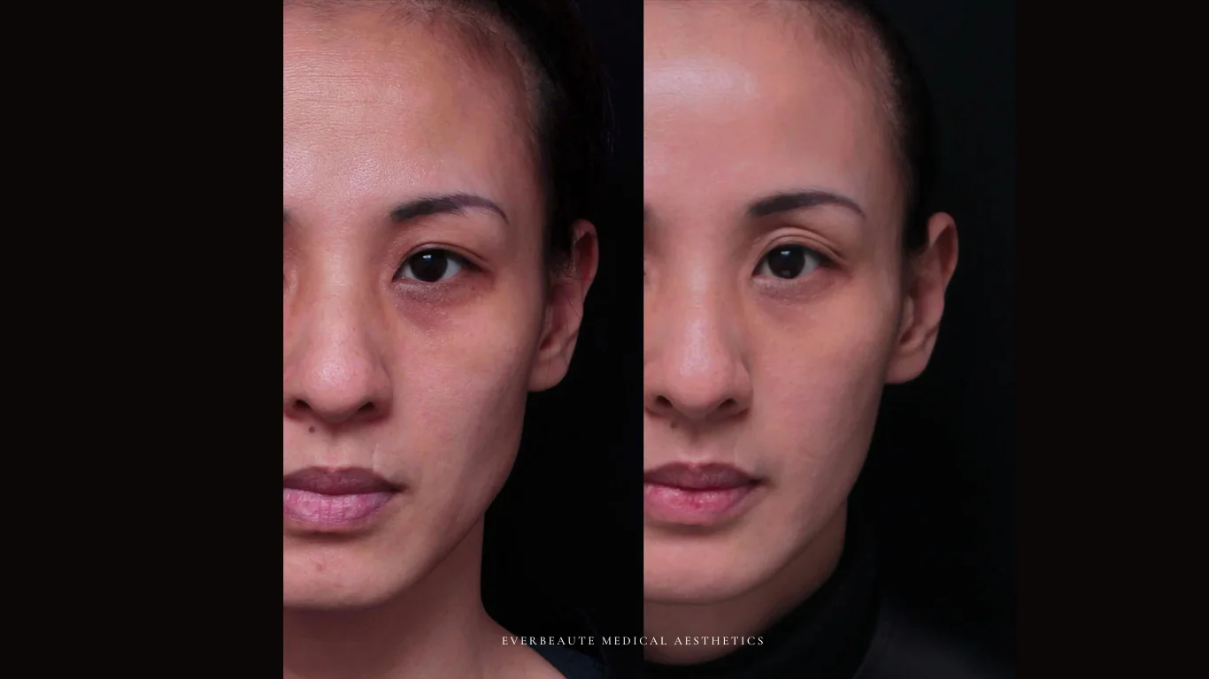 台北醫美推薦 大安區醫美 桃園微整 淚溝 眼袋 黑眼圈 豐唇 木偶紋 凝境美學診所 曾繁聞醫師 于曉恩醫師 皮膚科 專科 專業 效果自然 微整形 填補 填充 瑞士緹奧希 玻尿酸 喬雅登 水無痕 保柔緹 女神動態 熊貓針 淚溝針 童顏針 伊蓮絲 精靈針 喬雅露 逆時針 價格 副作用 後遺症 dcard ptt 成功案例 玻尿酸豐唇前後對比 豐唇、玻尿酸豐唇、自然豐唇、唇形改善、唇線重塑、唇峰設計、唇部微整形、豐唇注射推薦、自然飽滿唇、唇部玻尿酸 20