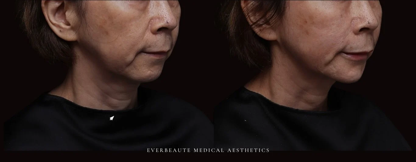 台北醫美推薦 大安區醫美 桃園微整 嘴邊肉下垂 下顎輪廓線 非手術 不動刀 無痕拉提 凝境美學診所 曾繁聞醫師 于曉恩醫師 皮膚科 專科 專業 好評 院長 原廠講師級 效果自然 微整形 填補 填充 瑞士緹奧希 玻尿酸 喬雅登 水無痕 保柔緹 女神動態 熊貓針 淚溝針 童顏針 伊蓮絲 精靈針 喬雅露 逆時針 價格 痛 副作用 後遺症 dcard ptt 成功案例 台北醫美 1