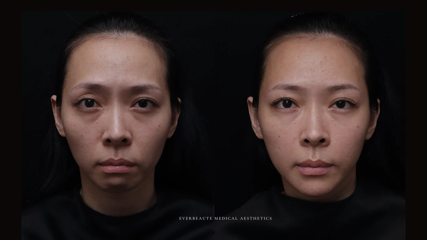 台北醫美推薦 大安區醫美 桃園微整 淚溝 眼袋 黑眼圈 豐唇 木偶紋 凝境美學診所 曾繁聞醫師 于曉恩醫師 皮膚科 專科 專業 效果自然 微整形 填補 填充 瑞士緹奧希 玻尿酸 喬雅登 水無痕 保柔緹 女神動態 熊貓針 淚溝針 童顏針 伊蓮絲 精靈針 喬雅露 逆時針 價格 副作用 後遺症 dcard ptt 成功案例 玻尿酸豐唇前後對比 豐唇、玻尿酸豐唇、自然豐唇、唇形改善、唇線重塑、唇峰設計、唇部微整形、豐唇注射推薦、自然飽滿唇、唇部玻尿酸 14