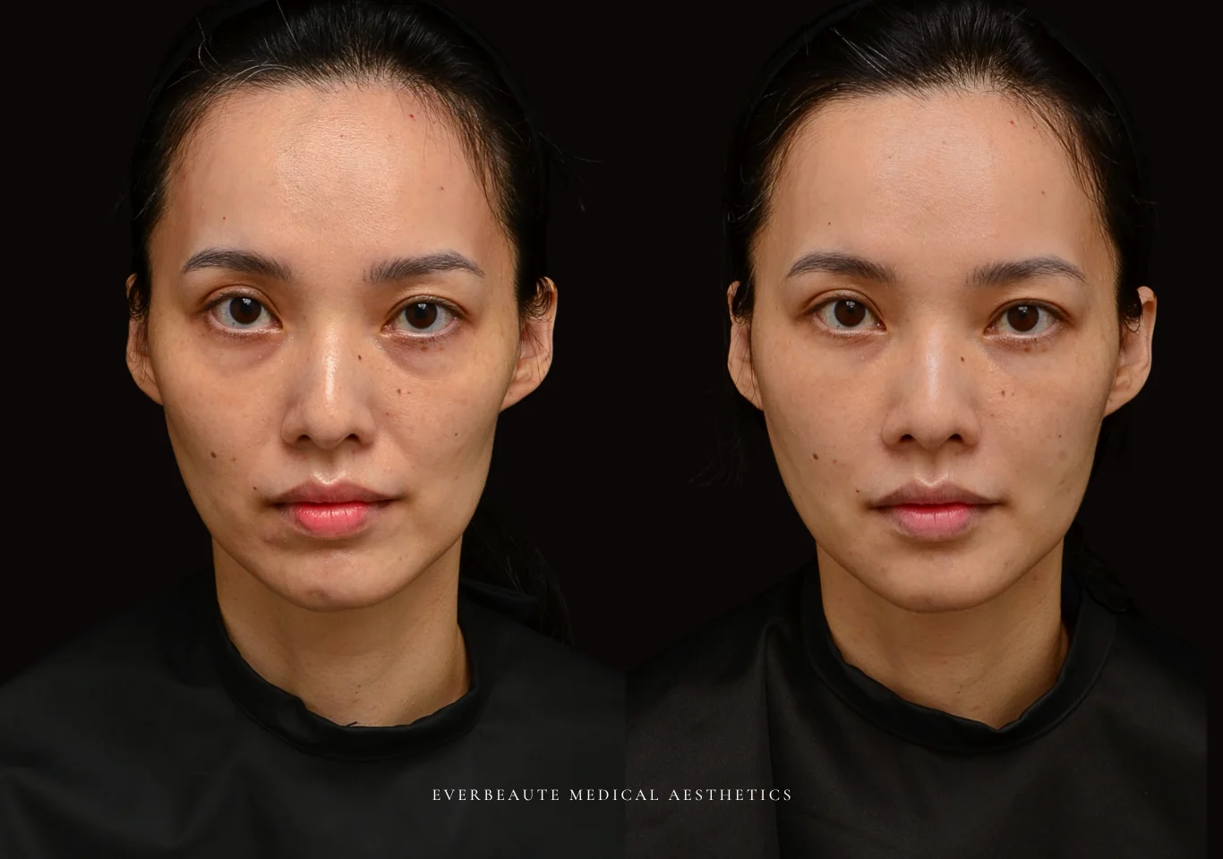 台北醫美推薦 大安區醫美 桃園微整 淚溝 眼袋 黑眼圈 木偶紋 法令紋 非手術 無痕拉提 凝境美學診所 曾繁聞醫師 于曉恩醫師 皮膚科 專科 專業 效果自然 微整形 填補 填充 瑞士緹奧希 玻尿酸 喬雅登 水無痕 保柔緹 女神動態 熊貓針 淚溝針 童顏針 伊蓮絲 精靈針 喬雅露 逆時針 價格 副作用 後遺症 dcard ptt 成功案例0000