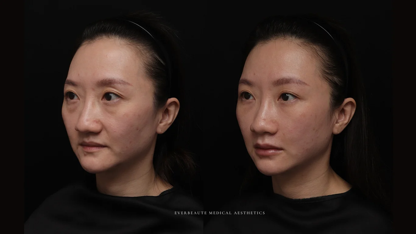 台北醫美推薦 大安區醫美 桃園微整 淚溝 眼袋 黑眼圈 豐唇 木偶紋 凝境美學診所 曾繁聞醫師 于曉恩醫師 皮膚科 專科 專業 效果自然 微整形 填補 填充 瑞士緹奧希 玻尿酸 喬雅登 水無痕 保柔緹 女神動態 熊貓針 淚溝針 童顏針 伊蓮絲 精靈針 喬雅露 逆時針 價格 副作用 後遺症 dcard ptt 成功案例 玻尿酸豐唇前後對比 豐唇、玻尿酸豐唇、自然豐唇、唇形改善、唇線重塑、唇峰設計、唇部微整形、豐唇注射推薦、自然飽滿唇、唇部玻尿酸 13