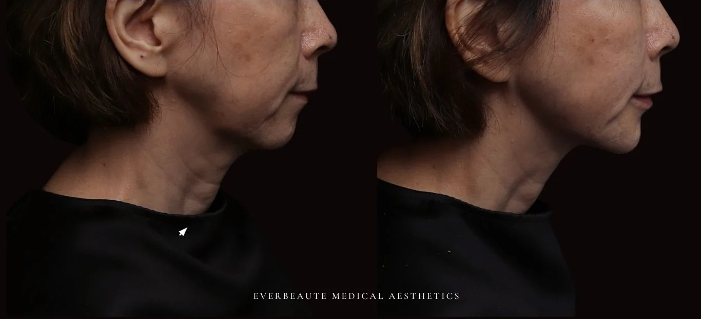 台北醫美推薦 大安區醫美 桃園微整 嘴邊肉下垂 下顎輪廓線 非手術 不動刀 無痕拉提 凝境美學診所 曾繁聞醫師 于曉恩醫師 皮膚科 專科 專業 好評 院長 原廠講師級 效果自然 微整形 填補 填充 瑞士緹奧希 玻尿酸 喬雅登 水無痕 保柔緹 女神動態 熊貓針 淚溝針 童顏針 伊蓮絲 精靈針 喬雅露 逆時針 價格 痛 副作用 後遺症 dcard ptt 成功案例 台北醫美