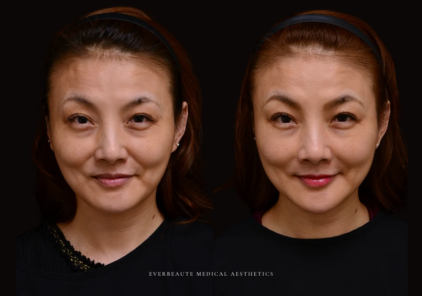 台北醫美推薦 大安區醫美 桃園微整 淚溝 眼袋 黑眼圈 法令紋 非手術 無痕拉提 凝境美學診所 曾繁聞醫師 于曉恩醫師 皮膚科 專科 專業 效果自然 微整形 填補 填充 瑞士緹奧希 玻尿酸 喬雅登 水無痕 保柔緹 女神動態 熊貓針 淚溝針 童顏針 伊蓮絲 精靈針 喬雅露 逆時針 價格 副作用 後遺症 dcard ptt 成功案例3333