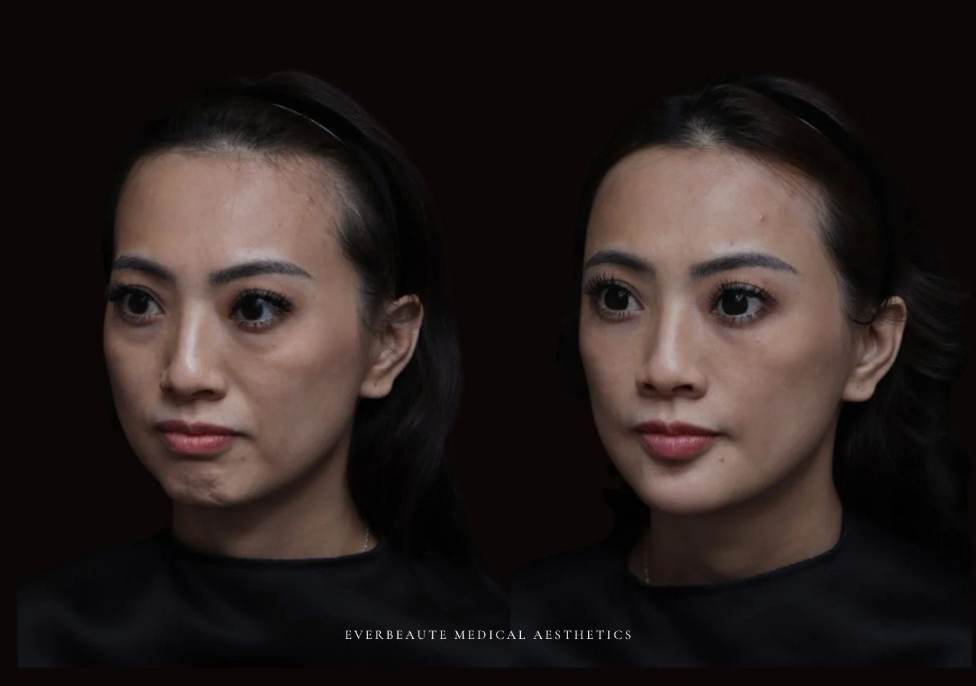 台北醫美推薦 大安區醫美 桃園微整 淚溝 眼袋 黑眼圈 木偶紋 蘋果肌 印地安紋 貓咪紋 嘴邊肉下垂 非手術 無痕拉提 凝境美學診所 曾繁聞醫師 于曉恩醫師 皮膚科 專科 專業 效果自然 微整形 填補 填充 瑞士緹奧希 玻尿酸 喬雅登 水無痕 保柔緹 女神動態 熊貓針 淚溝針 童顏針 伊蓮絲 精靈針 喬雅露 逆時針 價格 副作用 後遺症 dcard ptt 成功案例 雙下巴 下顎線