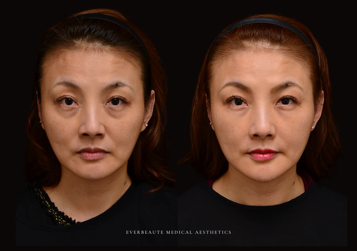 台北醫美推薦 大安區醫美 桃園微整 淚溝 眼袋 黑眼圈 法令紋 非手術 無痕拉提 凝境美學診所 曾繁聞醫師 于曉恩醫師 皮膚科 專科 專業 效果自然 微整形 填補 填充 瑞士緹奧希 玻尿酸 喬雅登 水無痕 保柔緹 女神動態 熊貓針 淚溝針 童顏針 伊蓮絲 精靈針 喬雅露 逆時針 價格 副作用 後遺症 dcard ptt 成功案例3332