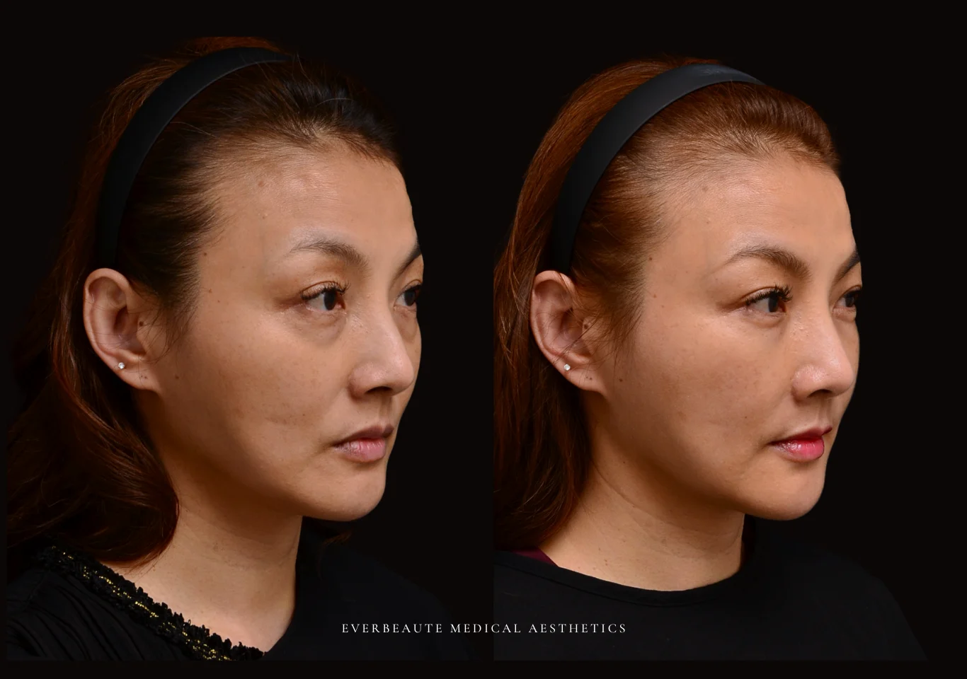 台北醫美推薦 大安區醫美 桃園微整 淚溝 眼袋 黑眼圈 法令紋 非手術 無痕拉提 凝境美學診所 曾繁聞醫師 于曉恩醫師 皮膚科 專科 專業 效果自然 微整形 填補 填充 瑞士緹奧希 玻尿酸 喬雅登 水無痕 保柔緹 女神動態 熊貓針 淚溝針 童顏針 伊蓮絲 精靈針 喬雅露 逆時針 價格 副作用 後遺症 dcard ptt 成功案例1010