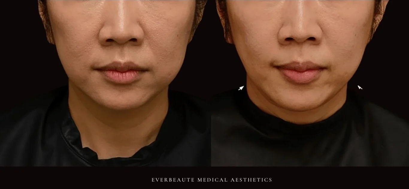 台北醫美推薦 大安區醫美 桃園微整 淚溝 眼袋 黑眼圈 木偶紋 蘋果肌 印地安紋 貓咪紋 嘴邊肉下垂 非手術 無痕拉提 凝境美學診所 曾繁聞醫師 于曉恩醫師 皮膚科 專科 專業 效果自然 微整形 填補 填充 瑞士緹奧希 玻尿酸 喬雅登 水無痕 保柔緹 女神動態 熊貓針 淚溝針 童顏針 伊蓮絲 精靈針 喬雅露 逆時針 價格 副作用 後遺症 dcard ptt 成功案例 0255 細紋皺紋 雙下巴 輪廓線 