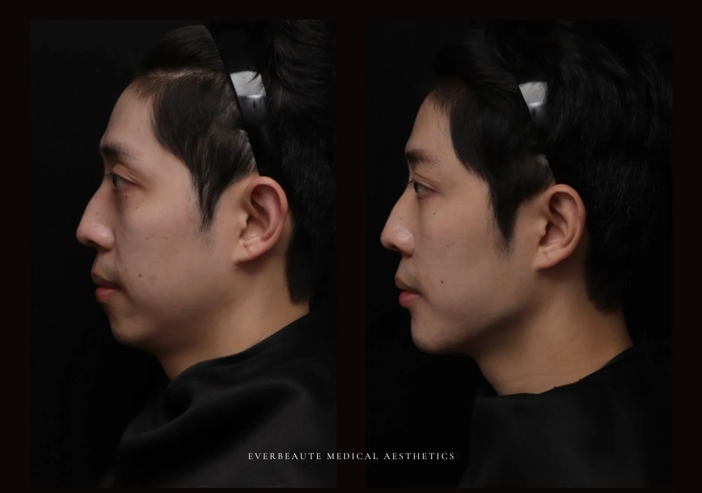 台北醫美推薦 大安區醫美 桃園微整 淚溝 眼袋 黑眼圈 木偶紋 蘋果肌 印地安紋 貓咪紋 嘴邊肉下垂 非手術 無痕拉提 凝境美學診所 曾繁聞醫師 于曉恩醫師 皮膚科 專科 專業 效果自然 微整形 填補 填充 瑞士緹奧希 玻尿酸 喬雅登 水無痕 保柔緹 女神動態 熊貓針 淚溝針 童顏針 伊蓮絲 精靈針 喬雅露 逆時針 價格 副作用 後遺症 dcard ptt 成功案例 02555