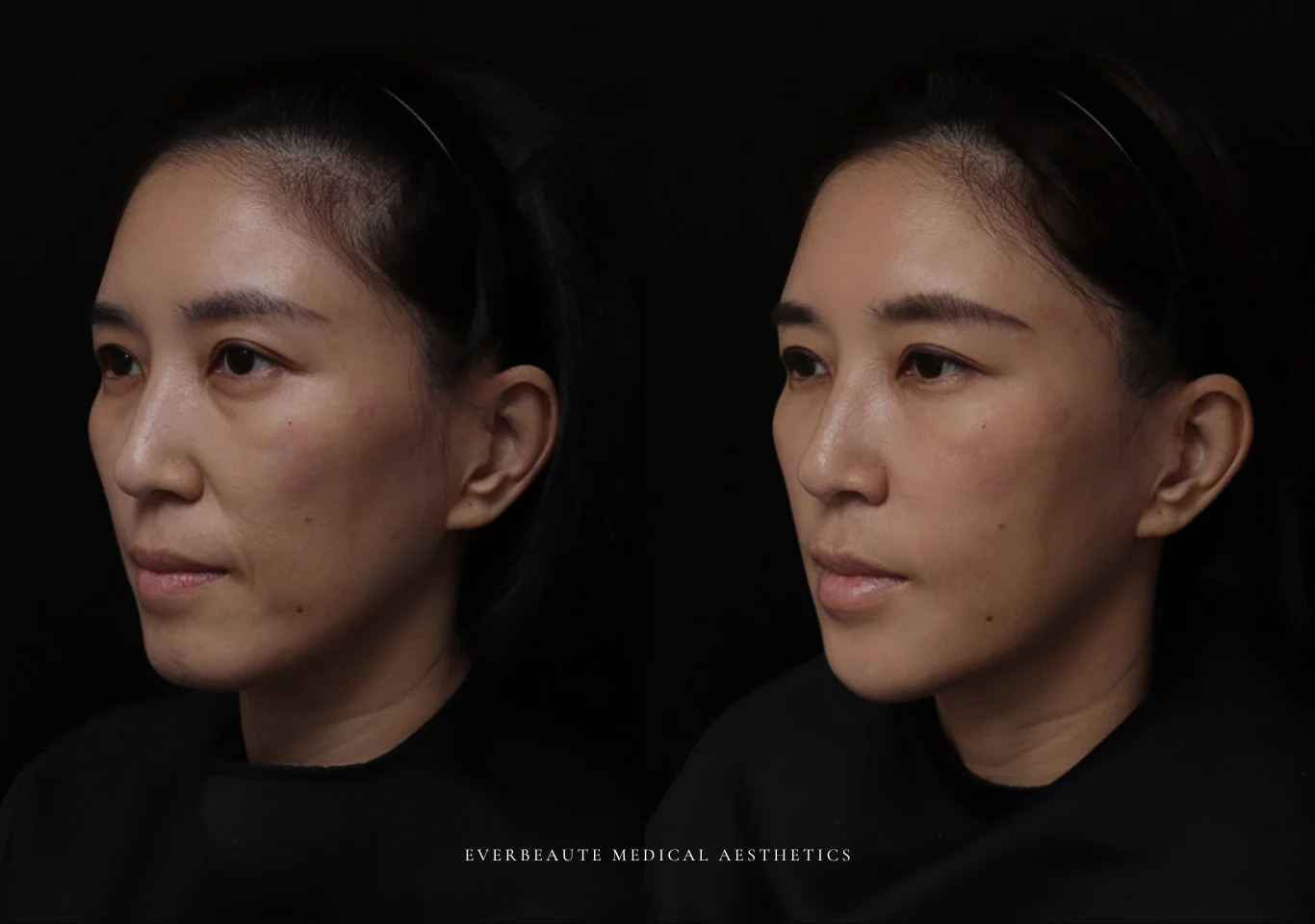 台北醫美推薦 大安區醫美 桃園微整 淚溝 眼袋 黑眼圈 木偶紋 蘋果肌 印地安紋 貓咪紋 嘴邊肉下垂 非手術 無痕拉提 凝境美學診所 曾繁聞醫師 于曉恩醫師 皮膚科 專科 專業 效果自然 微整形 填補 填充 瑞士緹奧希 玻尿酸 喬雅登 水無痕 保柔緹 女神動態 熊貓針 淚溝針 童顏針 伊蓮絲 精靈針 喬雅露 逆時針 價格 副作用 後遺症 dcard ptt 成功案例 0333333