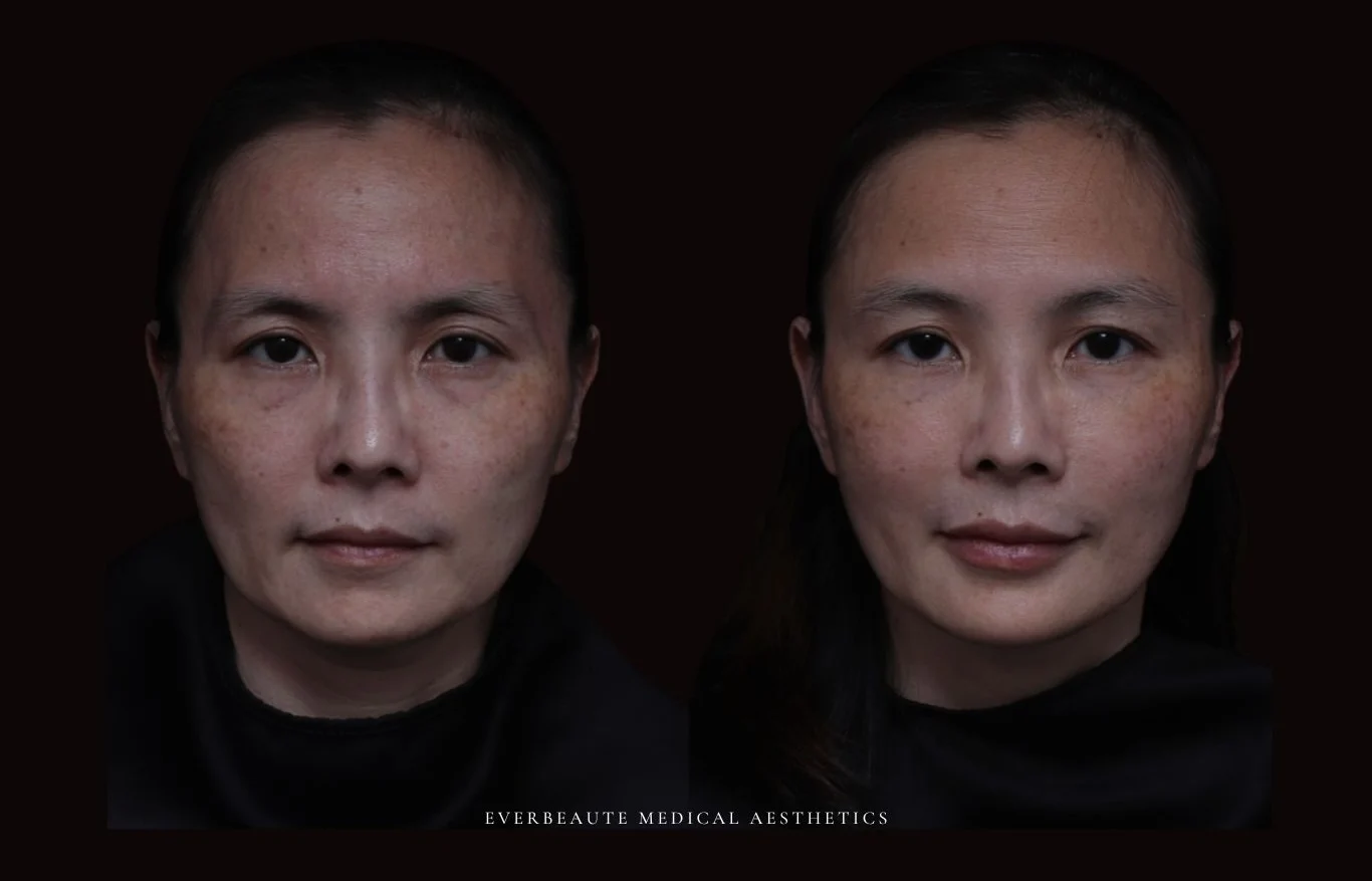 夫妻宮凹陷 太陽穴凹陷｜夫妻宮填補 台北醫美推薦 大安區醫美 桃園微整 淚溝 眼袋 黑眼圈 豐唇 木偶紋 凝境美學診所 曾繁聞醫師 于曉恩醫師 皮膚科 專科 專業 效果自然 微整形 填補 填充 瑞士緹奧希 玻尿酸 喬雅登 水無痕 保柔緹 女神動態 熊貓針 淚溝針 童顏針 伊蓮絲 精靈針 喬雅露 逆時針 價格 副作用 後遺症 dcard ptt 成功案例 玻尿酸豐唇前後對比 豐唇、玻尿酸豐唇、自然豐唇、唇形改善、唇線重塑、唇峰設計、唇部微整形、豐唇注射推薦、自然飽滿唇、唇部玻尿酸 20 凝境美學診所院長醫師擔任精靈針Aesthefill艾麗斯原廠國際級講師 示範注射教學案例 豐唇、太陽穴、臉頰凹陷、淚溝、蘋果肌 台北醫美診所