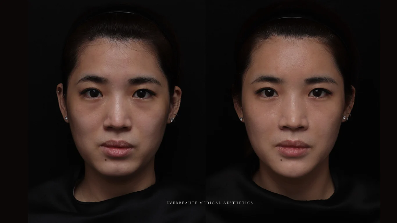 台北醫美推薦 大安區醫美 桃園微整 淚溝 眼袋 黑眼圈 豐唇 木偶紋 凝境美學診所 曾繁聞醫師 于曉恩醫師 皮膚科 專科 專業 效果自然 微整形 填補 填充 瑞士緹奧希 玻尿酸 喬雅登 水無痕 保柔緹 女神動態 熊貓針 淚溝針 童顏針 伊蓮絲 精靈針 喬雅露 逆時針 價格 副作用 後遺症 dcard ptt 成功案例 玻尿酸豐唇前後對比 豐唇、玻尿酸豐唇、自然豐唇、唇形改善、唇線重塑、唇峰設計、唇部微整形、豐唇注射推薦、自然飽滿唇、唇部玻尿酸 15