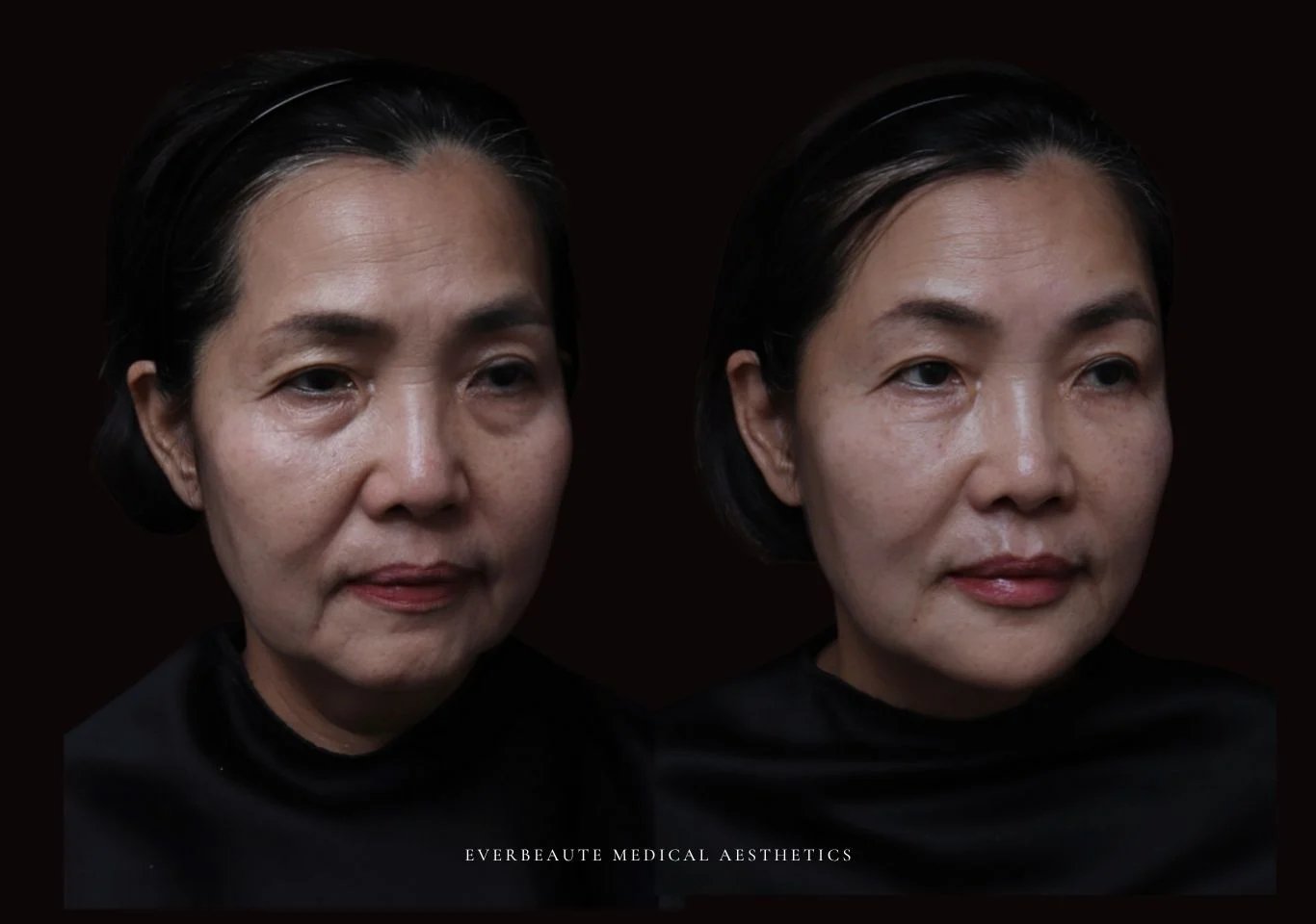 台北醫美推薦 大安區醫美 桃園微整 淚溝 眼袋 黑眼圈 木偶紋 蘋果肌 印地安紋 貓咪紋 嘴邊肉下垂 非手術 無痕拉提 凝境美學診所 曾繁聞醫師 于曉恩醫師 皮膚科 專科 專業 效果自然 微整形 填補 填充 瑞士緹奧希 玻尿酸 喬雅登 水無痕 保柔緹 女神動態 熊貓針 淚溝針 童顏針 伊蓮絲 精靈針 喬雅露 逆時針 價格 副作用 後遺症 dcard ptt 成功案例 0255 細紋皺紋 02