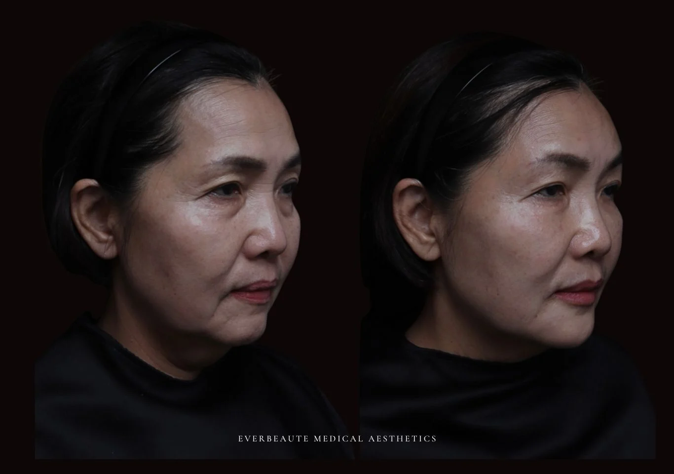 台北醫美推薦 大安區醫美 桃園微整 淚溝 眼袋 黑眼圈 木偶紋 蘋果肌 印地安紋 貓咪紋 嘴邊肉下垂 非手術 無痕拉提 凝境美學診所 曾繁聞醫師 于曉恩醫師 皮膚科 專科 專業 效果自然 微整形 填補 填充 瑞士緹奧希 玻尿酸 喬雅登 水無痕 保柔緹 女神動態 熊貓針 淚溝針 童顏針 伊蓮絲 精靈針 喬雅露 逆時針 價格 副作用 後遺症 dcard ptt 成功案例 0255 細紋皺紋 03