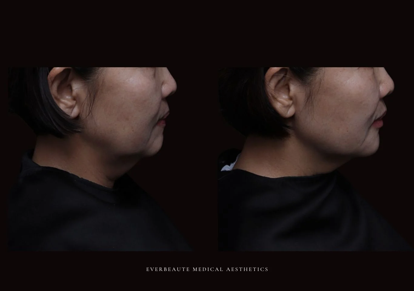 台北醫美推薦 大安區醫美 桃園微整 淚溝 眼袋 黑眼圈 木偶紋 蘋果肌 印地安紋 貓咪紋 嘴邊肉下垂 非手術 無痕拉提 凝境美學診所 曾繁聞醫師 于曉恩醫師 皮膚科 專科 專業 效果自然 微整形 填補 填充 瑞士緹奧希 玻尿酸 喬雅登 水無痕 保柔緹 女神動態 熊貓針 淚溝針 童顏針 伊蓮絲 精靈針 喬雅露 逆時針 價格 副作用 後遺症 dcard ptt 成功案例 0255 細紋皺紋 04