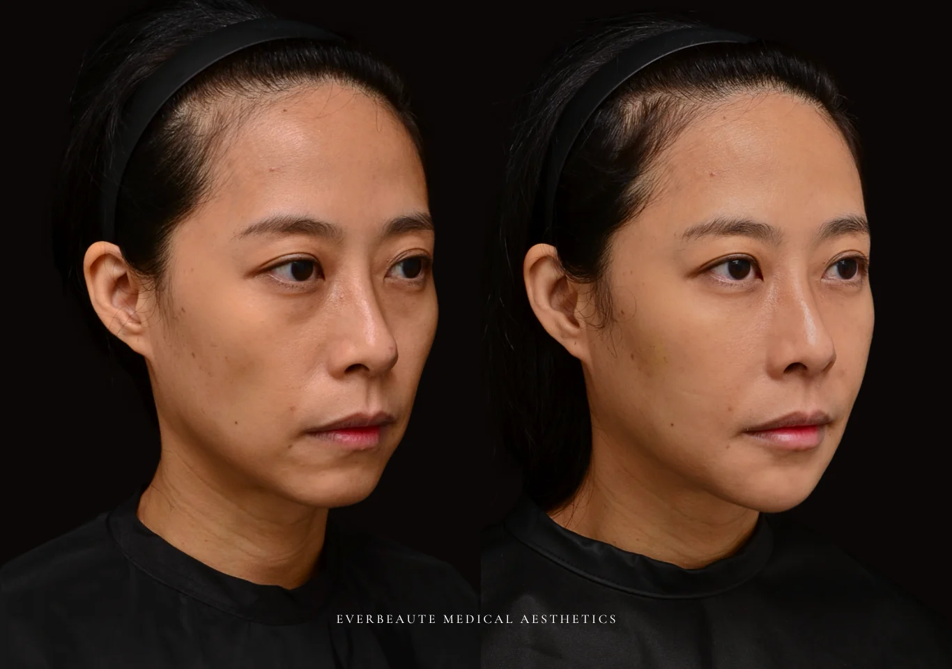 台北醫美推薦 大安區醫美 桃園微整 淚溝 眼袋 黑眼圈 木偶紋 蘋果肌 印地安紋 貓咪紋 豐唇 下巴 嘴邊肉下垂 非手術 無痕拉提 凝境美學診所 曾繁聞醫師 于曉恩醫師 皮膚科 專科 專業 效果自然 微整形 填補 填充 瑞士緹奧希 玻尿酸 喬雅登 水無痕 保柔緹 女神動態 熊貓針 淚溝針 童顏針 伊蓮絲 精靈針 喬雅露 逆時針 價格 副作用 後遺症 dcard ptt 成功案例555