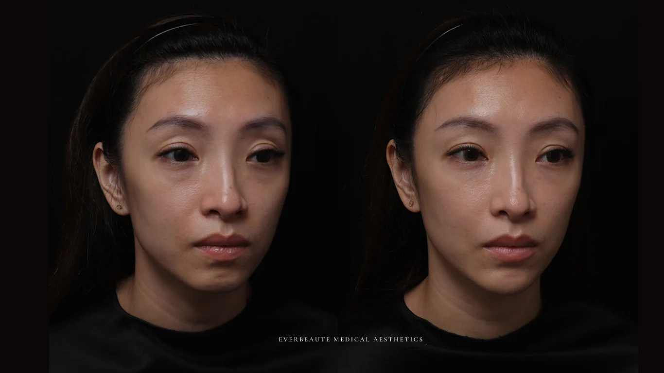 夫妻宮凹陷 太陽穴凹陷｜夫妻宮填補 台北醫美推薦 大安區醫美 桃園微整 淚溝 眼袋 黑眼圈 豐唇 木偶紋 凝境美學診所 曾繁聞醫師 于曉恩醫師 皮膚科 專科 專業 效果自然 微整形 填補 填充 瑞士緹奧希 玻尿酸 喬雅登 水無痕 保柔緹 女神動態 熊貓針 淚溝針 童顏針 伊蓮絲 精靈針 喬雅露 逆時針 價格 副作用 後遺症 dcard ptt 成功案例 玻尿酸豐唇前後對比 豐唇、玻尿酸豐唇、自然豐唇、唇形改善、唇線重塑、唇峰設計、唇部微整形、豐唇注射推薦、自然飽滿唇、唇部玻尿酸 20 凝境美學診所院長醫師擔任精靈針Aesthefill艾麗斯原廠國際級講師 示範注射教學案例 豐唇、太陽穴、臉頰凹陷、淚溝、蘋果肌 8