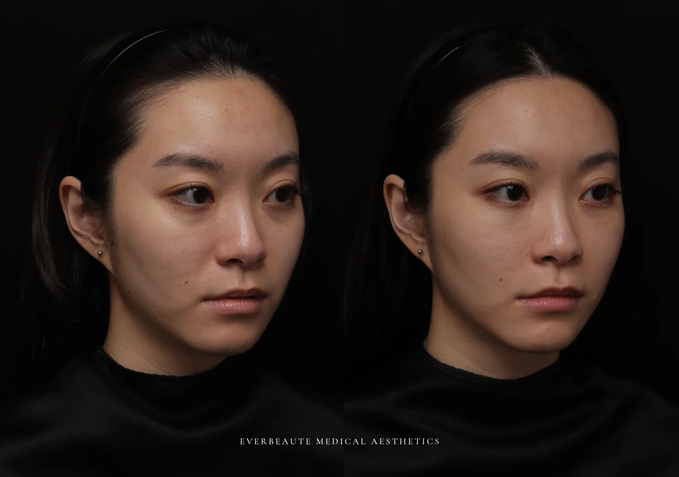 台北醫美推薦 大安區醫美 桃園微整 淚溝 眼袋 黑眼圈 木偶紋 蘋果肌 印地安紋 貓咪紋 嘴邊肉下垂 非手術 無痕拉提 凝境美學診所 曾繁聞醫師 于曉恩醫師 皮膚科 專科 專業 效果自然 微整形 填補 填充 瑞士緹奧希 玻尿酸 喬雅登 水無痕 保柔緹 女神動態 熊貓針 淚溝針 童顏針 伊蓮絲 精靈針 喬雅露 逆時針 價格 副作用 後遺症 dcard ptt 成功案例01