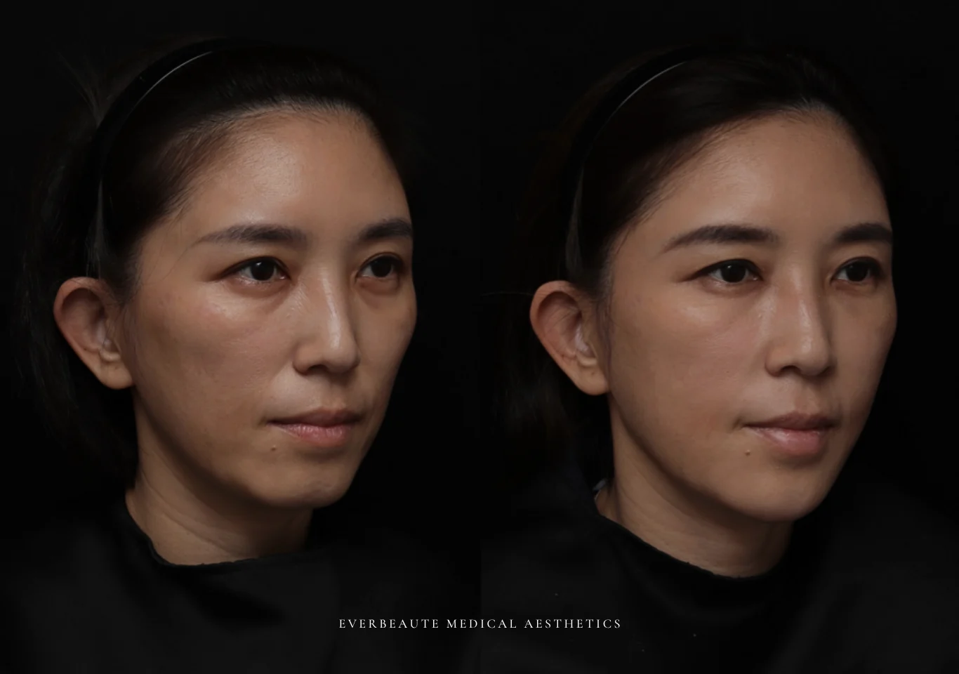 台北醫美推薦 大安區醫美 桃園微整 淚溝 眼袋 黑眼圈 木偶紋 蘋果肌 印地安紋 貓咪紋 嘴邊肉下垂 非手術 無痕拉提 凝境美學診所 曾繁聞醫師 于曉恩醫師 皮膚科 專科 專業 效果自然 微整形 填補 填充 瑞士緹奧希 玻尿酸 喬雅登 水無痕 保柔緹 女神動態 熊貓針 淚溝針 童顏針 伊蓮絲 精靈針 喬雅露 逆時針 價格 副作用 後遺症 dcard ptt 成功案例010