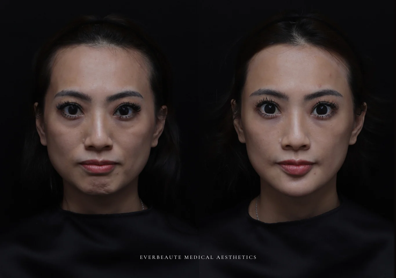 台北醫美推薦 大安區醫美 桃園微整 淚溝 眼袋 黑眼圈 木偶紋 蘋果肌 印地安紋 貓咪紋 嘴邊肉下垂 非手術 無痕拉提 凝境美學診所 曾繁聞醫師 于曉恩醫師 皮膚科 專科 專業 效果自然 微整形 填補 填充 瑞士緹奧希 玻尿酸 喬雅登 水無痕 保柔緹 女神動態 熊貓針 淚溝針 童顏針 伊蓮絲 精靈針 喬雅露 逆時針 價格 副作用 後遺症 dcard ptt 成功案例011