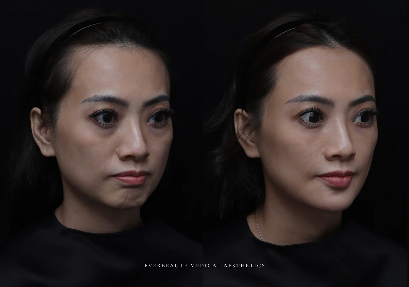 台北醫美推薦 大安區醫美 桃園微整 淚溝 眼袋 黑眼圈 木偶紋 蘋果肌 印地安紋 貓咪紋 嘴邊肉下垂 非手術 無痕拉提 凝境美學診所 曾繁聞醫師 于曉恩醫師 皮膚科 專科 專業 效果自然 微整形 填補 填充 瑞士緹奧希 玻尿酸 喬雅登 水無痕 保柔緹 女神動態 熊貓針 淚溝針 童顏針 伊蓮絲 精靈針 喬雅露 逆時針 價格 副作用 後遺症 dcard ptt 成功案例012