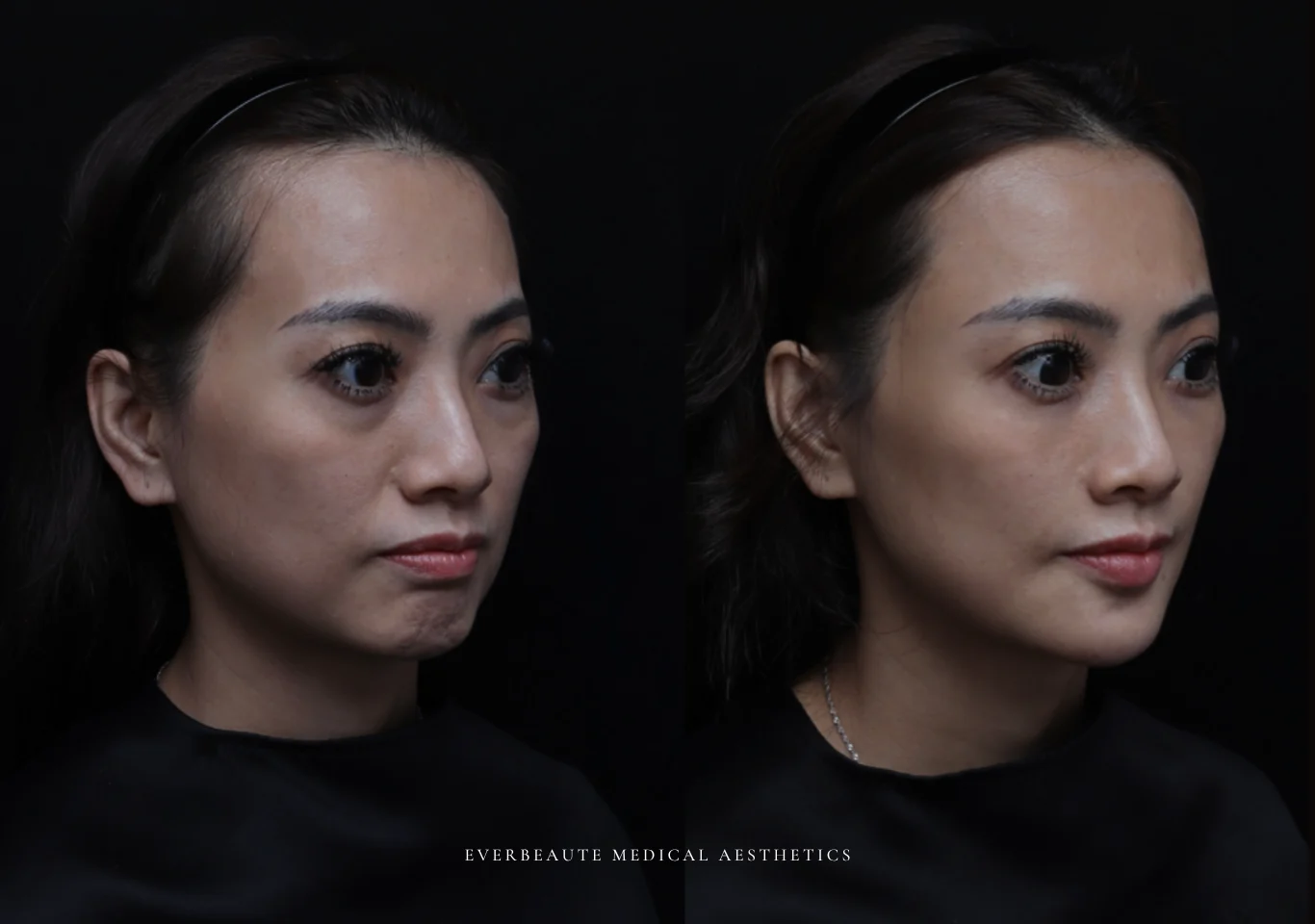 台北醫美推薦 大安區醫美 桃園微整 淚溝 眼袋 黑眼圈 木偶紋 蘋果肌 印地安紋 貓咪紋 嘴邊肉下垂 非手術 無痕拉提 凝境美學診所 曾繁聞醫師 于曉恩醫師 皮膚科 專科 專業 效果自然 微整形 填補 填充 瑞士緹奧希 玻尿酸 喬雅登 水無痕 保柔緹 女神動態 熊貓針 淚溝針 童顏針 伊蓮絲 精靈針 喬雅露 逆時針 價格 副作用 後遺症 dcard ptt 成功案例013