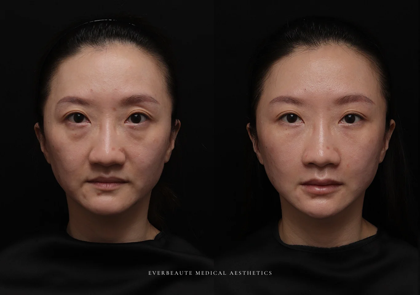 台北醫美推薦 大安區醫美 桃園微整 淚溝 眼袋 黑眼圈 木偶紋 蘋果肌 印地安紋 貓咪紋 嘴邊肉下垂 非手術 無痕拉提 凝境美學診所 曾繁聞醫師 于曉恩醫師 皮膚科 專科 專業 效果自然 微整形 填補 填充 瑞士緹奧希 玻尿酸 喬雅登 水無痕 保柔緹 女神動態 熊貓針 淚溝針 童顏針 伊蓮絲 精靈針 喬雅露 逆時針 價格 副作用 後遺症 dcard ptt 成功案例014