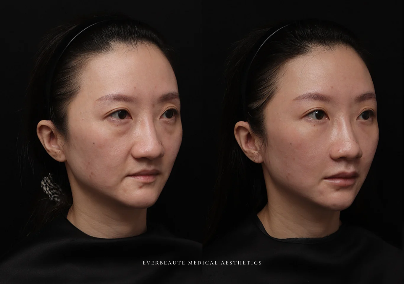 台北醫美推薦 大安區醫美 桃園微整 淚溝 眼袋 黑眼圈 木偶紋 蘋果肌 印地安紋 貓咪紋 嘴邊肉下垂 非手術 無痕拉提 凝境美學診所 曾繁聞醫師 于曉恩醫師 皮膚科 專科 專業 效果自然 微整形 填補 填充 瑞士緹奧希 玻尿酸 喬雅登 水無痕 保柔緹 女神動態 熊貓針 淚溝針 童顏針 伊蓮絲 精靈針 喬雅露 逆時針 價格 副作用 後遺症 dcard ptt 成功案例 015