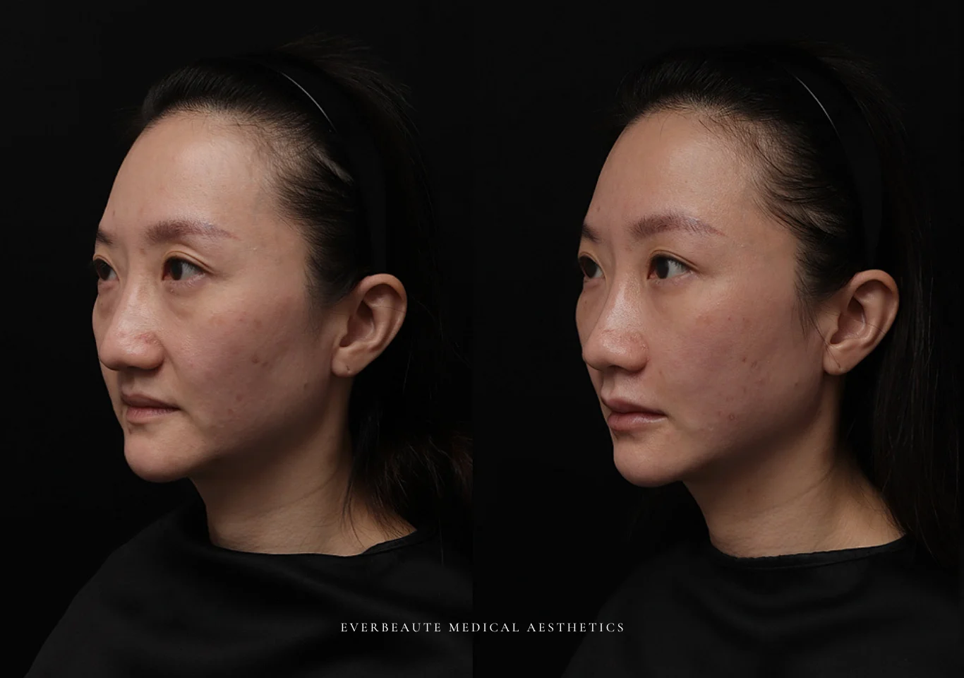 台北醫美推薦 大安區醫美 桃園微整 淚溝 眼袋 黑眼圈 木偶紋 蘋果肌 印地安紋 貓咪紋 嘴邊肉下垂 非手術 無痕拉提 凝境美學診所 曾繁聞醫師 于曉恩醫師 皮膚科 專科 專業 效果自然 微整形 填補 填充 瑞士緹奧希 玻尿酸 喬雅登 水無痕 保柔緹 女神動態 熊貓針 淚溝針 童顏針 伊蓮絲 精靈針 喬雅露 逆時針 價格 副作用 後遺症 dcard ptt 成功案例 016