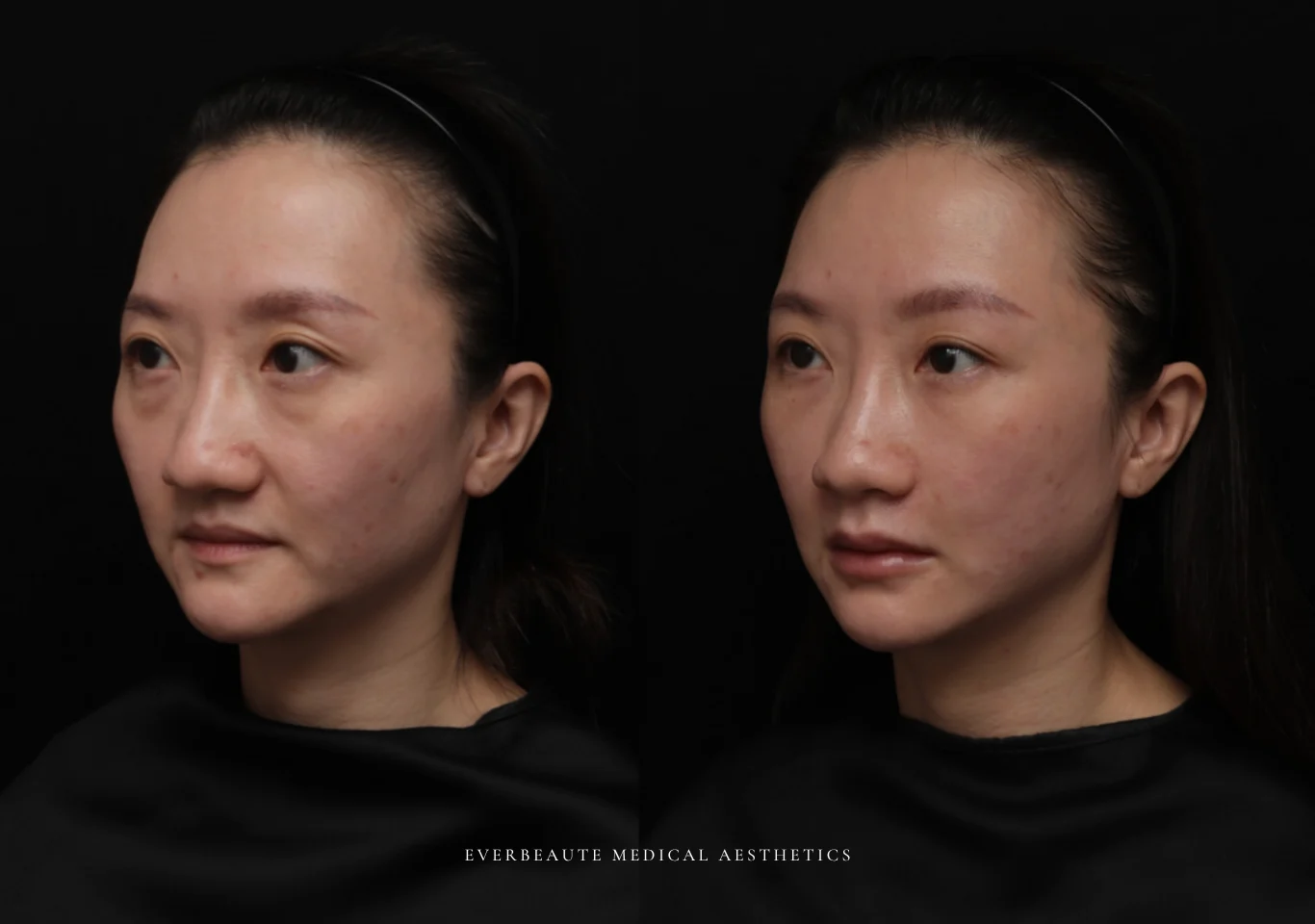 台北醫美推薦 大安區醫美 桃園微整 淚溝 眼袋 黑眼圈 木偶紋 蘋果肌 印地安紋 貓咪紋 嘴邊肉下垂 非手術 無痕拉提 凝境美學診所 曾繁聞醫師 于曉恩醫師 皮膚科 專科 專業 效果自然 微整形 填補 填充 瑞士緹奧希 玻尿酸 喬雅登 水無痕 保柔緹 女神動態 熊貓針 淚溝針 童顏針 伊蓮絲 精靈針 喬雅露 逆時針 價格 副作用 後遺症 dcard ptt 成功案例 017