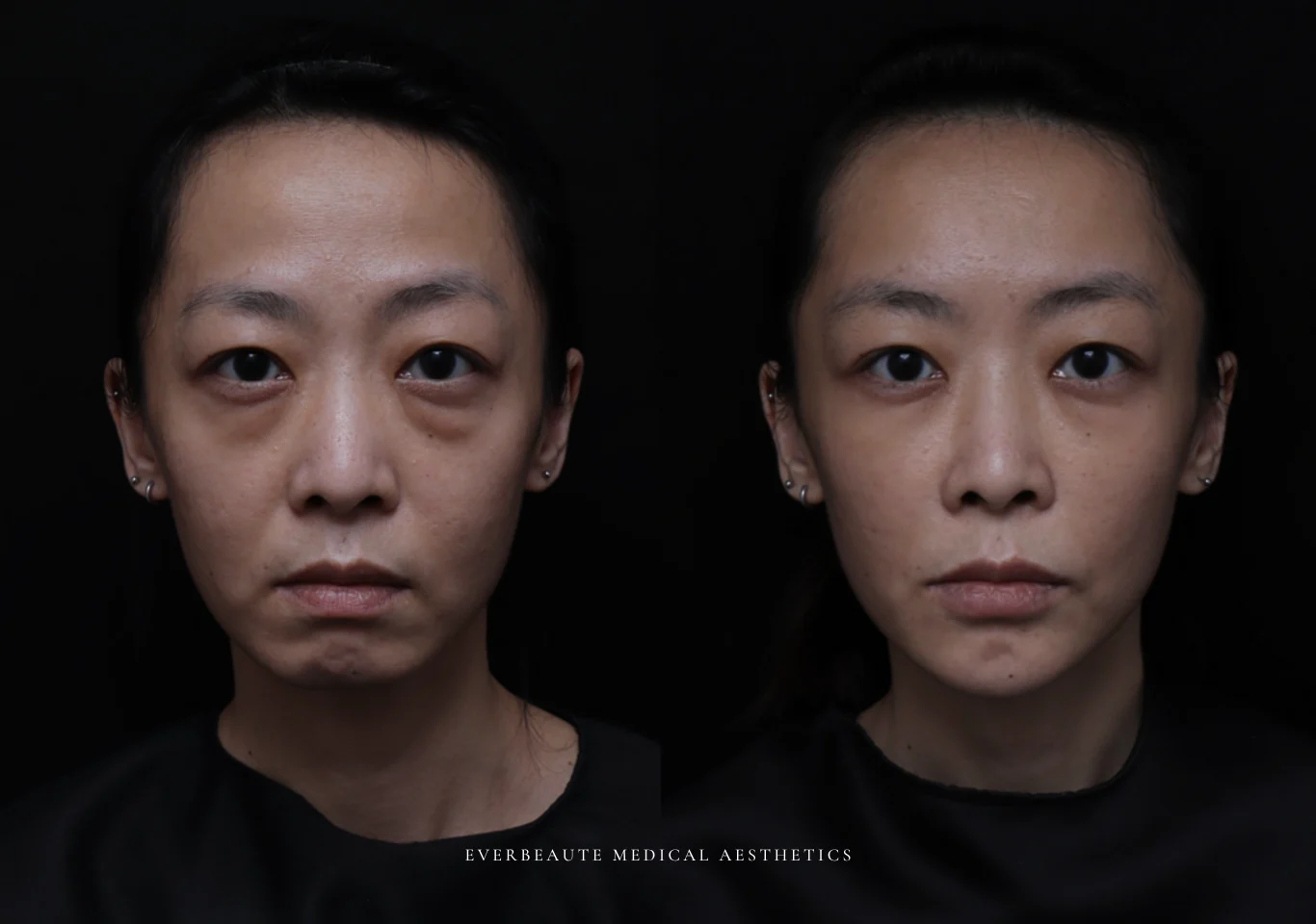 台北醫美推薦 大安區醫美 桃園微整 淚溝 眼袋 黑眼圈 木偶紋 蘋果肌 印地安紋 貓咪紋 嘴邊肉下垂 非手術 無痕拉提 凝境美學診所 曾繁聞醫師 于曉恩醫師 皮膚科 專科 專業 效果自然 微整形 填補 填充 瑞士緹奧希 玻尿酸 喬雅登 水無痕 保柔緹 女神動態 熊貓針 淚溝針 童顏針 伊蓮絲 精靈針 喬雅露 逆時針 價格 副作用 後遺症 dcard ptt 成功案例 018