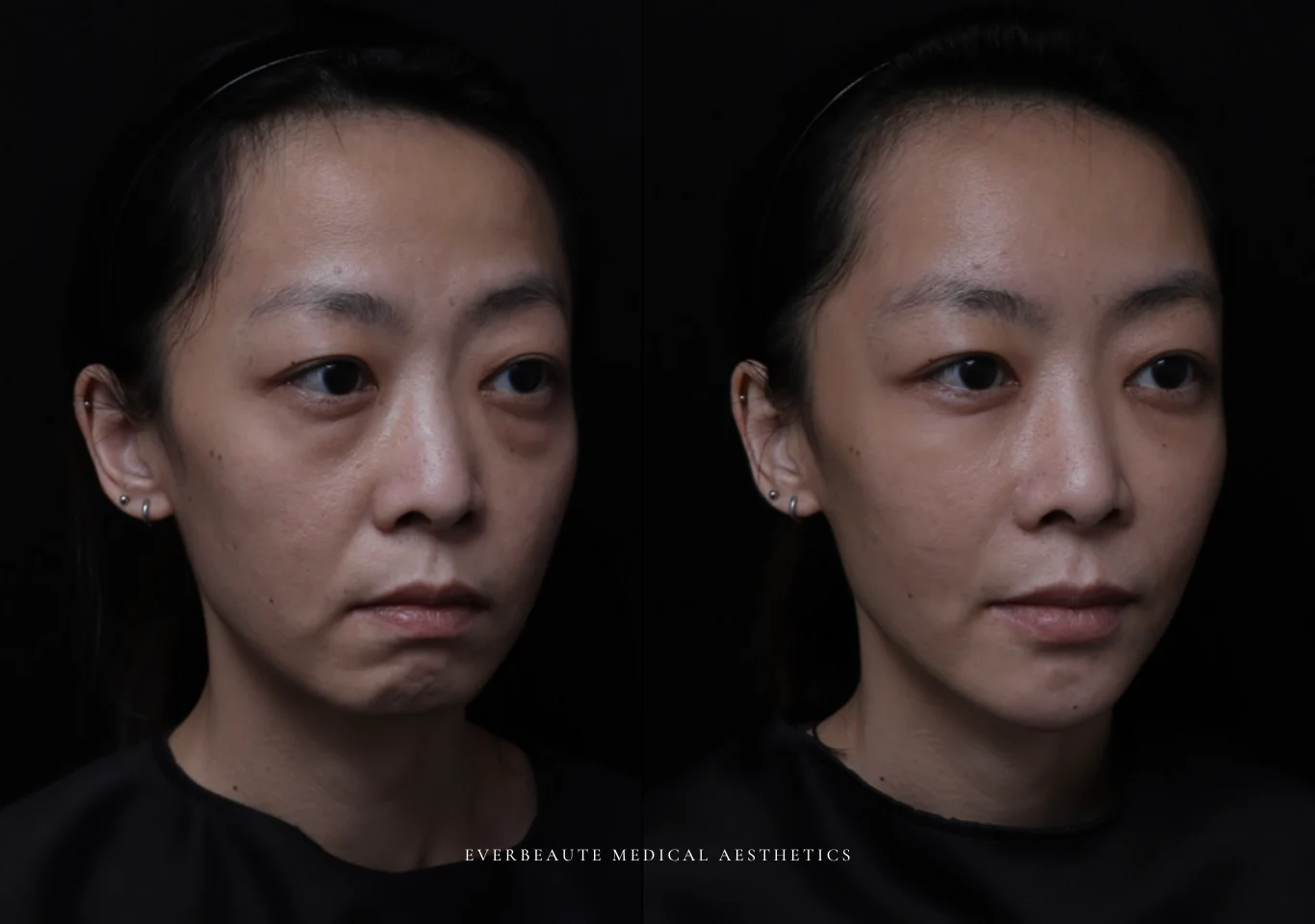 台北醫美推薦 大安區醫美 桃園微整 淚溝 眼袋 黑眼圈 木偶紋 蘋果肌 印地安紋 貓咪紋 嘴邊肉下垂 非手術 無痕拉提 凝境美學診所 曾繁聞醫師 于曉恩醫師 皮膚科 專科 專業 效果自然 微整形 填補 填充 瑞士緹奧希 玻尿酸 喬雅登 水無痕 保柔緹 女神動態 熊貓針 淚溝針 童顏針 伊蓮絲 精靈針 喬雅露 逆時針 價格 副作用 後遺症 dcard ptt 成功案例 019