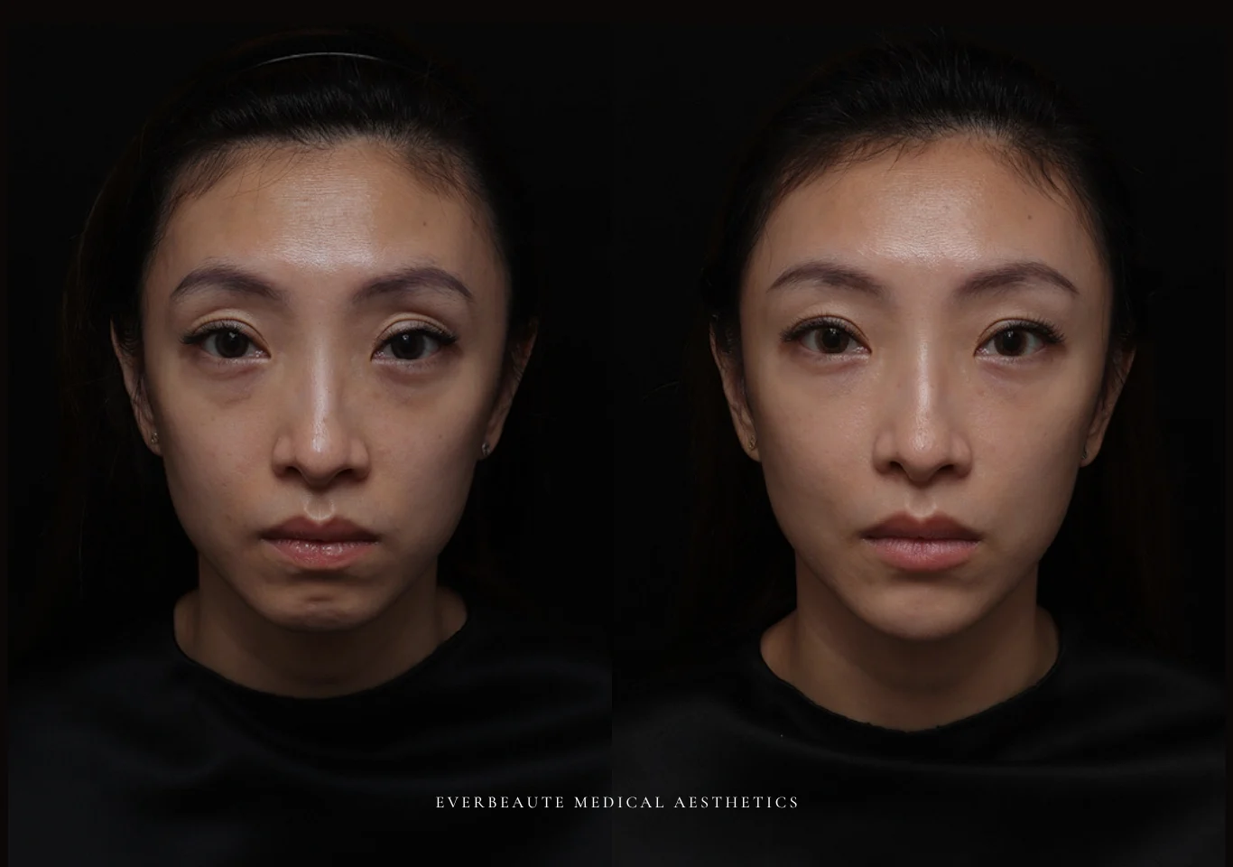 台北醫美推薦 大安區醫美 桃園微整 淚溝 眼袋 黑眼圈 木偶紋 蘋果肌 印地安紋 貓咪紋 嘴邊肉下垂 非手術 無痕拉提 凝境美學診所 曾繁聞醫師 于曉恩醫師 皮膚科 專科 專業 效果自然 微整形 填補 填充 瑞士緹奧希 玻尿酸 喬雅登 水無痕 保柔緹 女神動態 熊貓針 淚溝針 童顏針 伊蓮絲 精靈針 喬雅露 逆時針 價格 副作用 後遺症 dcard ptt 成功案例02