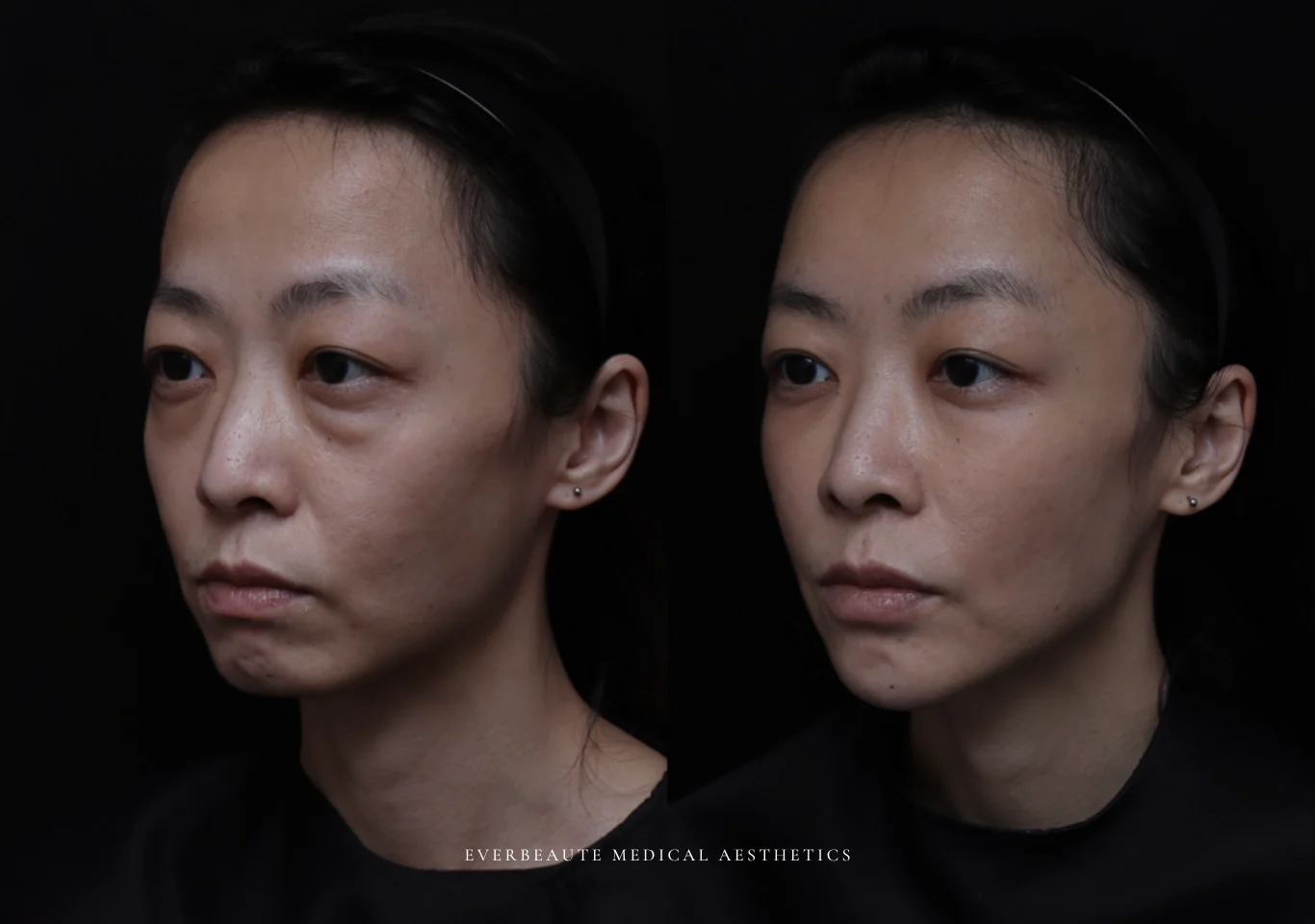 台北醫美推薦 大安區醫美 桃園微整 淚溝 眼袋 黑眼圈 木偶紋 蘋果肌 印地安紋 貓咪紋 嘴邊肉下垂 非手術 無痕拉提 凝境美學診所 曾繁聞醫師 于曉恩醫師 皮膚科 專科 專業 效果自然 微整形 填補 填充 瑞士緹奧希 玻尿酸 喬雅登 水無痕 保柔緹 女神動態 熊貓針 淚溝針 童顏針 伊蓮絲 精靈針 喬雅露 逆時針 價格 副作用 後遺症 dcard ptt 成功案例 020