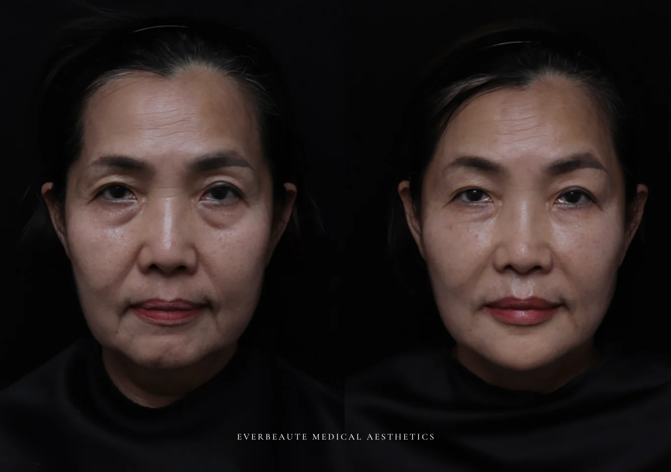 台北醫美推薦 大安區醫美 桃園微整 淚溝 眼袋 黑眼圈 木偶紋 蘋果肌 印地安紋 貓咪紋 嘴邊肉下垂 非手術 無痕拉提 凝境美學診所 曾繁聞醫師 于曉恩醫師 皮膚科 專科 專業 效果自然 微整形 填補 填充 瑞士緹奧希 玻尿酸 喬雅登 水無痕 保柔緹 女神動態 熊貓針 淚溝針 童顏針 伊蓮絲 精靈針 喬雅露 逆時針 價格 副作用 後遺症 dcard ptt 成功案例 023