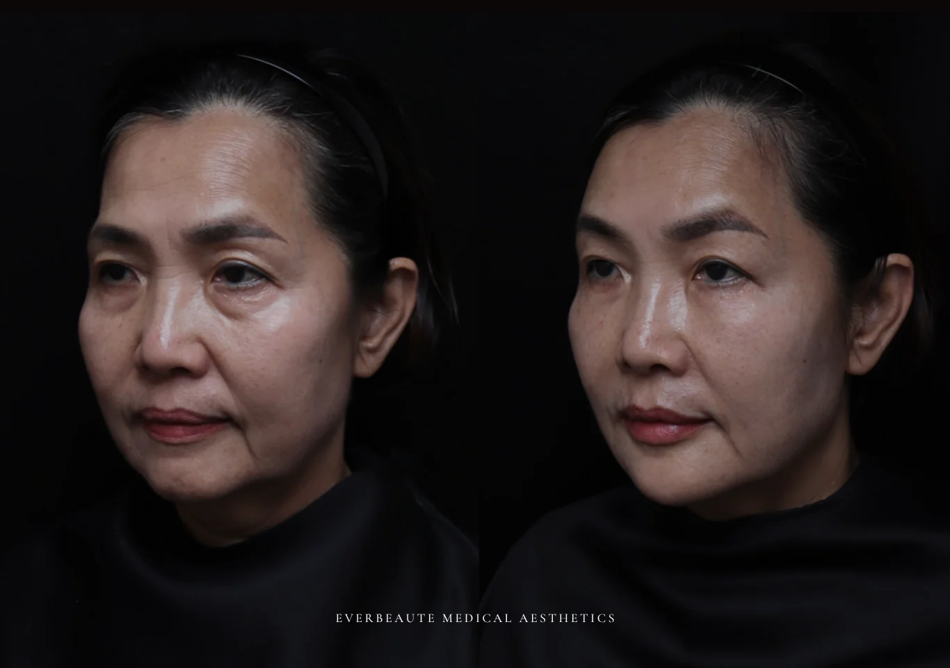 台北醫美推薦 大安區醫美 桃園微整 淚溝 眼袋 黑眼圈 木偶紋 蘋果肌 印地安紋 貓咪紋 嘴邊肉下垂 非手術 無痕拉提 凝境美學診所 曾繁聞醫師 于曉恩醫師 皮膚科 專科 專業 效果自然 微整形 填補 填充 瑞士緹奧希 玻尿酸 喬雅登 水無痕 保柔緹 女神動態 熊貓針 淚溝針 童顏針 伊蓮絲 精靈針 喬雅露 逆時針 價格 副作用 後遺症 dcard ptt 成功案例 024