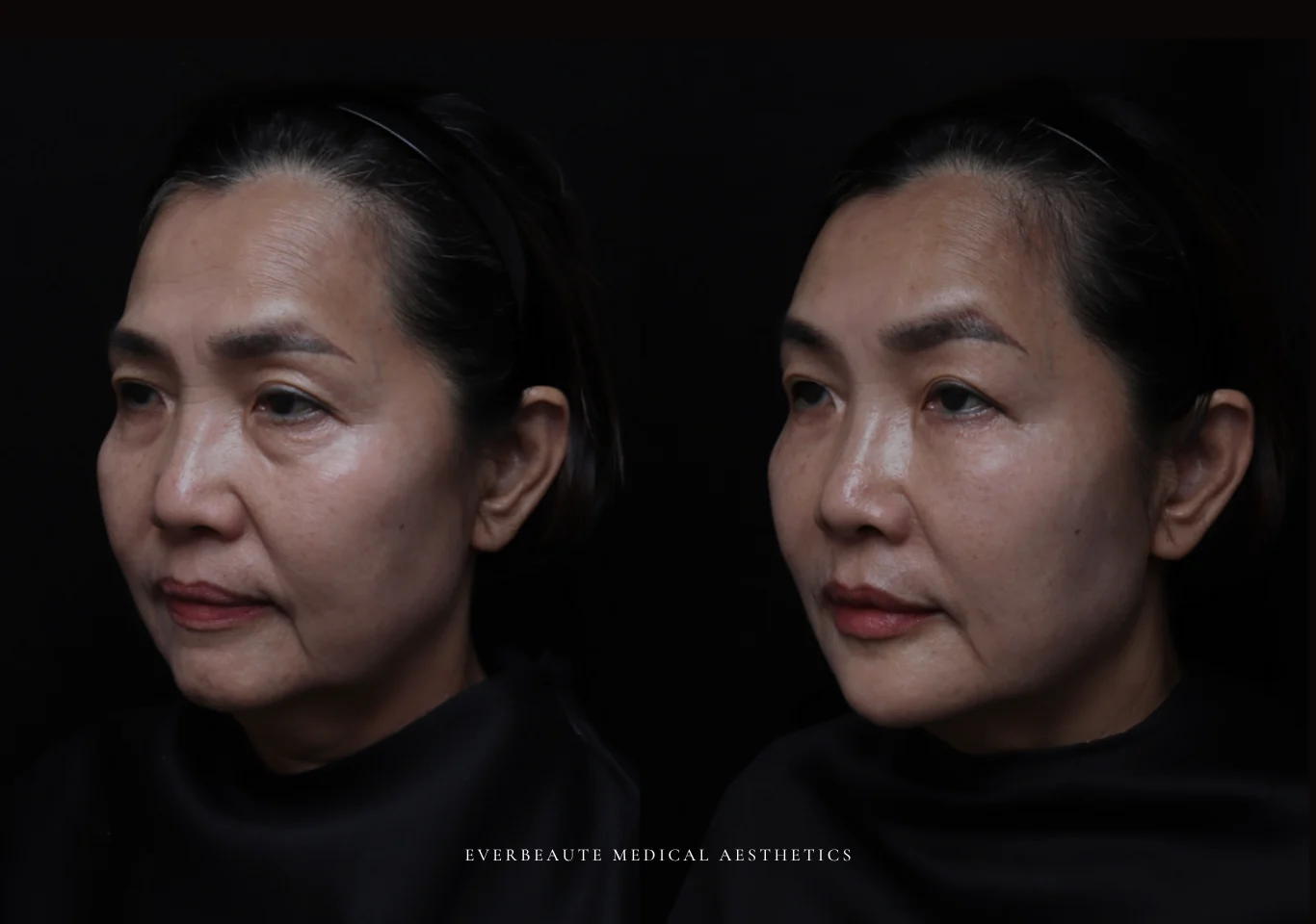 台北醫美推薦 大安區醫美 桃園微整 淚溝 眼袋 黑眼圈 木偶紋 蘋果肌 印地安紋 貓咪紋 嘴邊肉下垂 非手術 無痕拉提 凝境美學診所 曾繁聞醫師 于曉恩醫師 皮膚科 專科 專業 效果自然 微整形 填補 填充 瑞士緹奧希 玻尿酸 喬雅登 水無痕 保柔緹 女神動態 熊貓針 淚溝針 童顏針 伊蓮絲 精靈針 喬雅露 逆時針 價格 副作用 後遺症 dcard ptt 成功案例 025