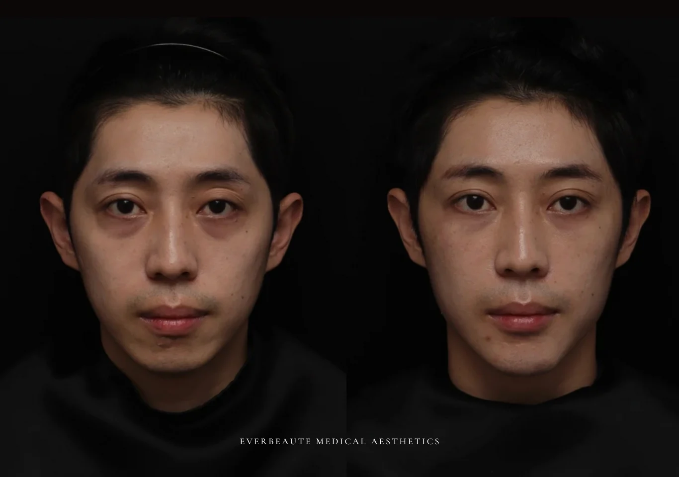 台北醫美推薦 大安區醫美 桃園微整 淚溝 眼袋 黑眼圈 木偶紋 蘋果肌 印地安紋 貓咪紋 嘴邊肉下垂 非手術 無痕拉提 凝境美學診所 曾繁聞醫師 于曉恩醫師 皮膚科 專科 專業 效果自然 微整形 填補 填充 瑞士緹奧希 玻尿酸 喬雅登 水無痕 保柔緹 女神動態 熊貓針 淚溝針 童顏針 伊蓮絲 精靈針 喬雅露 逆時針 價格 副作用 後遺症 dcard ptt 成功案例 026