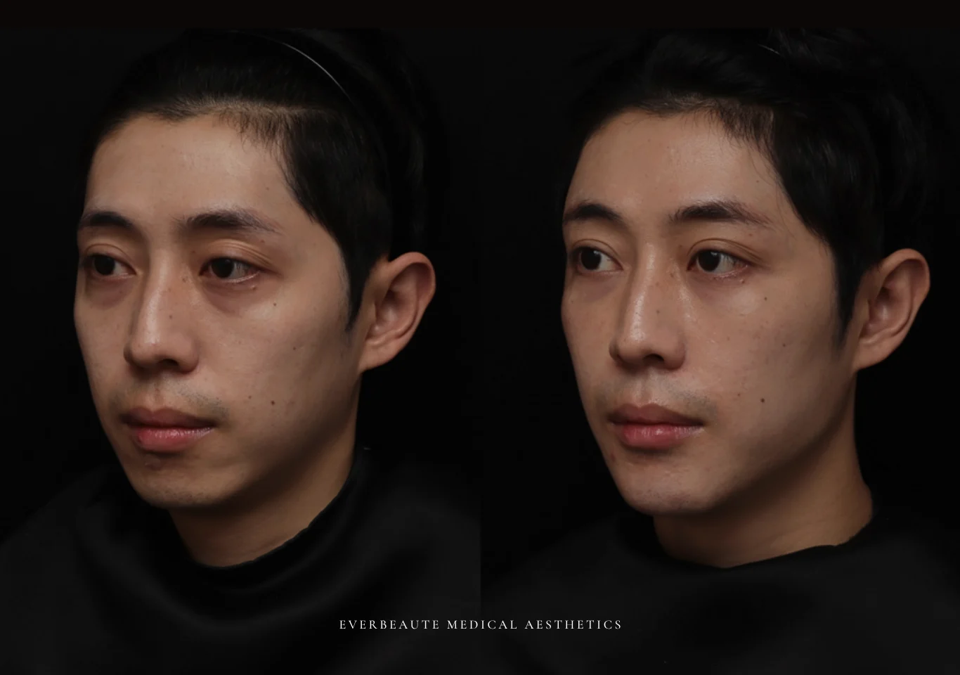 台北醫美推薦 大安區醫美 桃園微整 淚溝 眼袋 黑眼圈 木偶紋 蘋果肌 印地安紋 貓咪紋 嘴邊肉下垂 非手術 無痕拉提 凝境美學診所 曾繁聞醫師 于曉恩醫師 皮膚科 專科 專業 效果自然 微整形 填補 填充 瑞士緹奧希 玻尿酸 喬雅登 水無痕 保柔緹 女神動態 熊貓針 淚溝針 童顏針 伊蓮絲 精靈針 喬雅露 逆時針 價格 副作用 後遺症 dcard ptt 成功案例 027