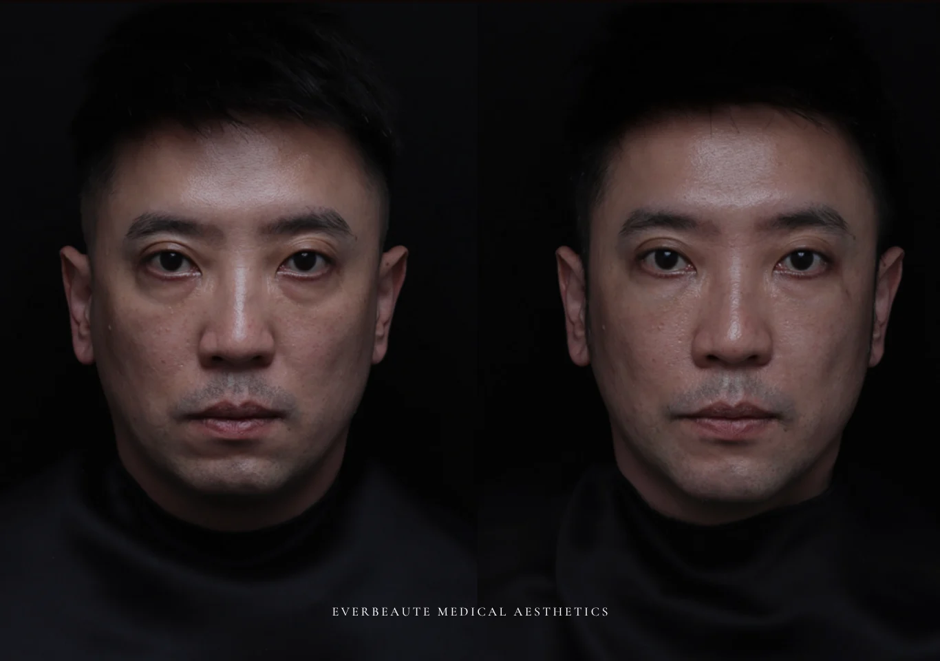 台北醫美推薦 大安區醫美 桃園微整 淚溝 眼袋 黑眼圈 木偶紋 蘋果肌 印地安紋 貓咪紋 嘴邊肉下垂 非手術 無痕拉提 凝境美學診所 曾繁聞醫師 于曉恩醫師 皮膚科 專科 專業 效果自然 微整形 填補 填充 瑞士緹奧希 玻尿酸 喬雅登 水無痕 保柔緹 女神動態 熊貓針 淚溝針 童顏針 伊蓮絲 精靈針 喬雅露 逆時針 價格 副作用 後遺症 dcard ptt 成功案例 028