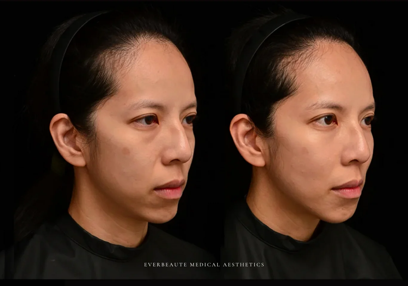 台北醫美推薦 大安區醫美 桃園微整 淚溝 眼袋 黑眼圈 木偶紋 蘋果肌 印地安紋 貓咪紋 嘴邊肉下垂 非手術 無痕拉提 凝境美學診所 曾繁聞醫師 于曉恩醫師 皮膚科 專科 專業 效果自然 微整形 填補 填充 瑞士緹奧希 玻尿酸 喬雅登 水無痕 保柔緹 女神動態 熊貓針 淚溝針 童顏針 伊蓮絲 精靈針 喬雅露 逆時針 價格 副作用 後遺症 dcard ptt 成功案例 029