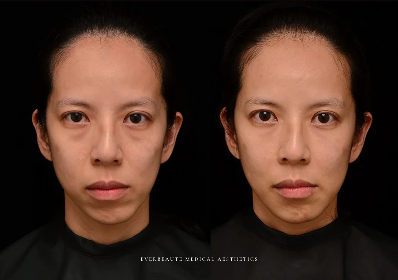 台北醫美推薦 大安區醫美 桃園微整 淚溝 眼袋 黑眼圈 木偶紋 蘋果肌 印地安紋 貓咪紋 嘴邊肉下垂 非手術 無痕拉提 凝境美學診所 曾繁聞醫師 于曉恩醫師 皮膚科 專科 專業 效果自然 微整形 填補 填充 瑞士緹奧希 玻尿酸 喬雅登 水無痕 保柔緹 女神動態 熊貓針 淚溝針 童顏針 伊蓮絲 精靈針 喬雅露 逆時針 價格 副作用 後遺症 dcard ptt 成功案例 030