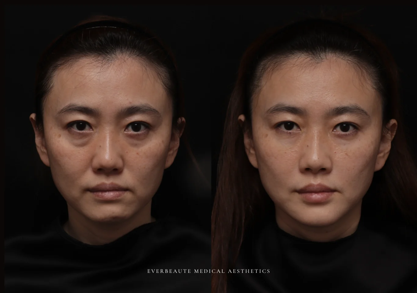 台北醫美推薦 大安區醫美 桃園微整 淚溝 眼袋 黑眼圈 木偶紋 蘋果肌 印地安紋 貓咪紋 嘴邊肉下垂 非手術 無痕拉提 凝境美學診所 曾繁聞醫師 于曉恩醫師 皮膚科 專科 專業 效果自然 微整形 填補 填充 瑞士緹奧希 玻尿酸 喬雅登 水無痕 保柔緹 女神動態 熊貓針 淚溝針 童顏針 伊蓮絲 精靈針 喬雅露 逆時針 價格 副作用 後遺症 dcard ptt 成功案例03